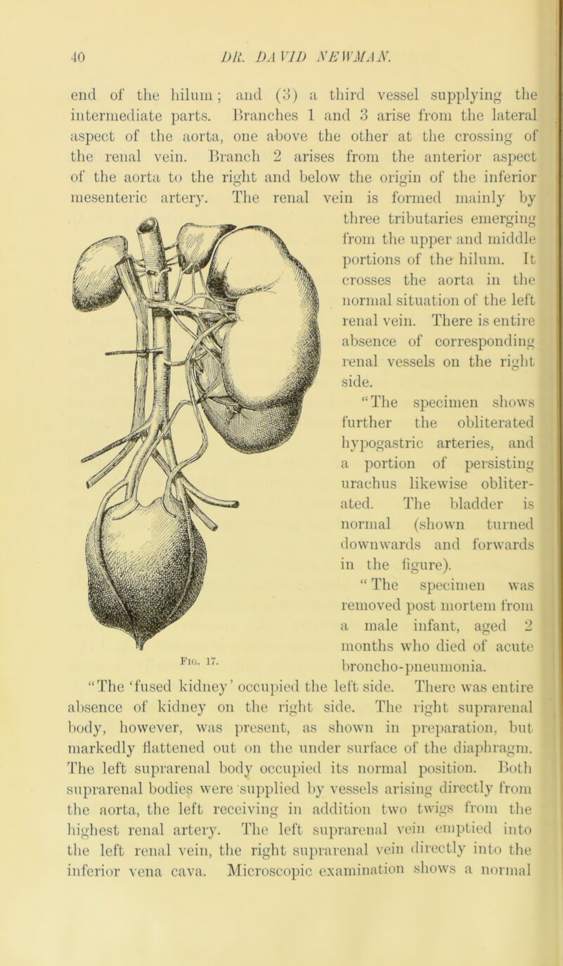 end of the liilum; and (3) a third vessel supplying the intermediate parts. Branches 1 and 3 arise from the lateral aspect of the aorta, one above the other at the crossing of the renal vein. Branch 2 arises from the anterior aspect of the aorta to the right and below the origin of the inferior mesenteric artery. The renal vein is formed mainly by three tributaries emerging from the upper and middle portions of the hilum. It crosses the aorta in the normal situation of the left renal vein. There is entire absence of corresponding renal vessels on the rmlit o side. “ The specimen shows further the obliterated hypogastric arteries, and a portion of persisting urachus likewise obliter- ated. The bladder is normal (shown turned downwards and forwards in the figure). “ The specimen was removed post mortem from a male infant, aged 2 months who died of acute broncho-pneumonia. “The ‘fused kidney’ occupied the left side. There was entire absence of kidney on the right side. The right suprarenal body, however, was present, as shown in preparation, but markedly flattened out on the under surface of the diaphragm. The left suprarenal body occupied its normal position. Both suprarenal bodies were supplied by vessels arising directly from the aorta, the left receiving in addition two twigs from the highest renal artery. The left suprarenal vein emptied into the left renal vein, the right suprarenal vein directly into the inferior vena cava. Microscopic examination shows a normal