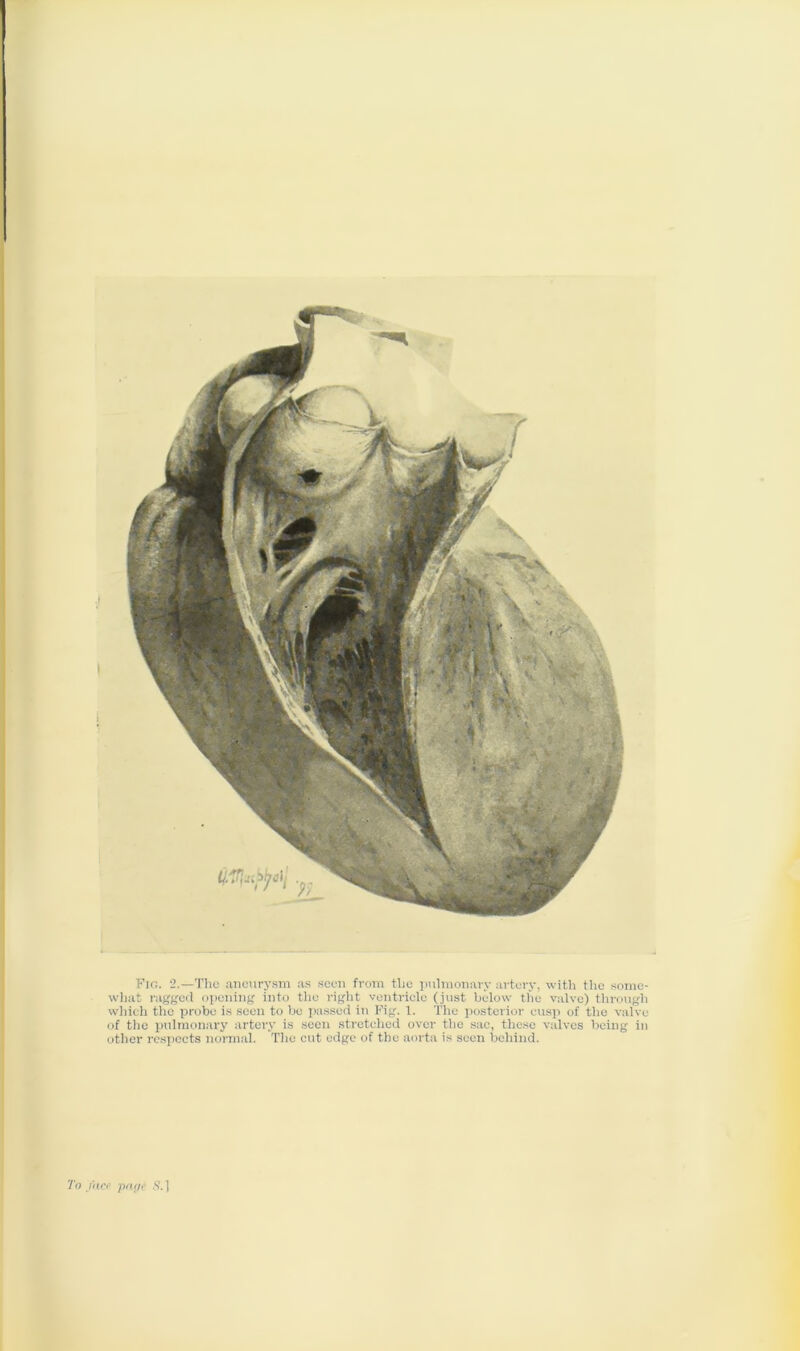 Fir;. 2.—The aneurysm as seen from the pulmonary artery, with the some- what ragged opening into the right ventricle (just below the valve) through which the probe is seen to be passed in Fig. 1. The posterior cusp of the valve of the pulmonary artery is seen stretched over the sac, these valves being in other respects normal. The cut edge of the aorta is seen behind. Tn face prute 5.]