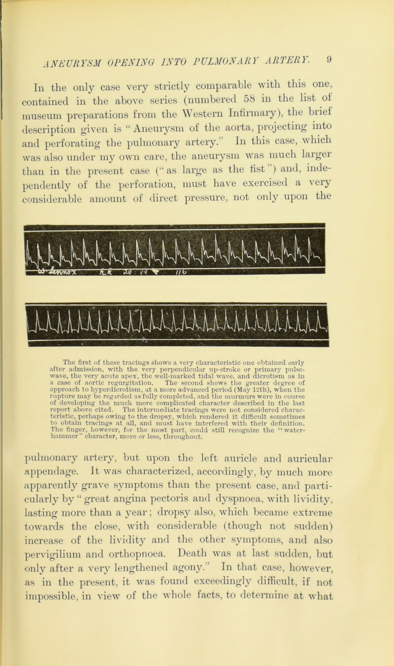 In the only case very strictly comparable with this one, contained in the above series (numbered 58 in the list of museum preparations from the Western Infirmary), the brief description given is “ Aneurysm of the aorta, projecting into and perforating the pulmonary artery. In this case, which was also under my own care, the aneurysm was much larger than in the present case (“ as large as the fist ) and, inde- pendently of the perforation, must have exercised a very considerable amount of direct pressure, not only upon the The first of these tracings shows a very characteristic one obtained early after admission, with the very perpendicular np-stroke or primary pulse- wave, the very acute apex, the well-marked tidal wave, and dicrotism ns in a case of aortic regurgitation. The second shows the greater degree of approach to hyperdicrotism, at a more advanced period (May 12th), when the rupture may be regarded as fully completed, and the murmurs were in course of developing the much more complicated character described in the last report above cited. The intermediate tracings were not considered charac- teristic, perhaps owing to the dropsy, which rendered it difficult sometimes to obtain tracings at all, and must have interfered with their definition. The finger, however, for the most part, could still recognize the “water- hammer” character, more or less, throughout. pulmonary artery, but upon the left auricle and auricular appendage. It was characterized, accordingly, by much more apparently grave symptoms than the present case, and parti- cularly by “great angina pectoris and dyspnoea, with lividity, lasting more than a year; dropsy also, which became extreme towards the close, with considerable (though not sudden) increase of the lividity and the other symptoms, and also pervigilium and orthopnoea. Death was at last sudden, but only after a very lengthened agony. In that case, however, as in the present, it was found exceedingly difficult, if not impossible, in view of the whole facts, to determine at what