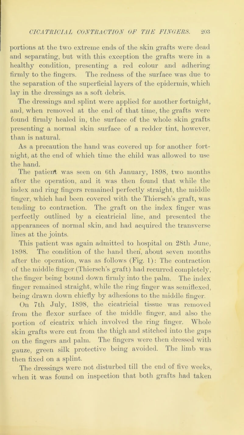 CICATRICIAL CONTRA CTION OF TllF FI NO ERR. 20:$ portions at the two extreme ends of the skin grafts were dead and separating, but with this exception the grafts were in a healthy condition, presenting a red colour and adhering firmly to the fingers. The redness of the surface was due to the separation of the superficial layers of the epidermis, which lay in the dressings as a soft debris. The dressings and splint were applied for another fortnight, and, when removed at the end of that time, the grafts were found firmly healed in, the surface of the whole skin grafts presenting a normal skin surface of a redder tint, however, than is natural. As a precaution the hand was covered up for another fort- night, at the end of which time the child was allowed to use the hand. The patient was seen on Gth January, 1898, two months after the operation, and it was then found that while the index and ring fingers remained perfectly straight, the middle finger, which had been covered with the Thiersch’s graft, was tending to contraction. The graft on the index finger was perfectly outlined by a cicatricial line, and presented the appearances of normal skin, and had acquired the transverse lines at the joints. This patient was again admitted to hospital on 28th June, 1898. The condition of the hand then, about seven months after the operation, was as follows (Fig. 1): The contraction of the middle finger (Thiersch’s graft) had recurred completely, the finger being bound down firmly into the palm. The index finger remained straight, while the ring finger was semiflexed, being drawn down chiefly by adhesions to the middle finger. On 7th July, 1898, the cicatricial tissue was removed from the flexor surface of the middle finger, and also the portion of cicatrix which involved the ring finger. Whole skin grafts were cut from the thigh and stitched into the gaps on the fingers and palm. The fingers were then dressed with gauze, green silk protective being avoided. The limb was then fixed on a splint. The dressings were not disturbed till the end of five weeks, when it was found on inspection that both grafts had taken