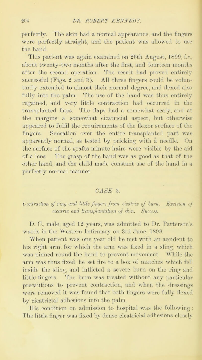 perfectly. The skin had a normal appearance, and the fingers were perfectly straight, and the patient was allowed to use the hand. This patient was again examined on 2Gth August, 1899, he., about twenty-two months after the first, and fourteen months after the second operation. The result had proved entirely successful (Figs. 2 and 3). All three fingers could be volun- tarily extended to almost their normal degree, and flexed also fully into the palm. The use of the hand was thus entirely regained, and very little contraction had occurred in the transplanted flaps. The flaps had a somewhat scaly, and at the margins a somewhat cicatricial aspect, but otherwise appeared to fulfil the requirements of the flexor surface of the fingers. Sensation over the entire transplanted part was apparently normal, as tested by pricking with a needle. On the surface of the grafts minute hairs were visible by the aid of a lens. The grasp of the hand was as good as that of the other hand, and the child made constant use of the hand in a perfectly normal manner. CASE 3. Contraction of ring and little fingers from cicatrix of burn. Excision of cicatrix and transplantation of skin. Success. 1). C., male, aged 12 years, was admitted to Dr. Patterson’s wards in the Western Infirmary on 3rd June, 1898. When patient was one year old he met with an accident to his right arm, for which the arm was fixed in a sling, which was pinned round the hand to prevent movement. While the arm was thus fixed, he set fire to a box of matches which fell inside the sling, and inflicted a severe burn on the ring and little fingers. The burn was treated without any particular precautions to prevent contraction, and when the dressings were removed it was found that both fingers were fully flexed by cicatricial adhesions into the palm. His condition on admission to hospital was the following: The little finger was fixed by dense cicatricial adhesions closely