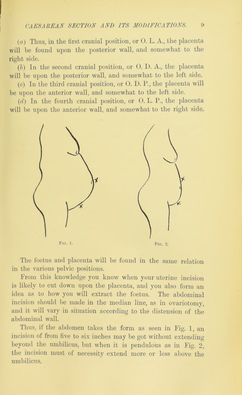 {a) Thus, in the first cranial position, or 0. L. A., the placenta will be found upon the posterior wall, and somewhat to the right side. (h) In the second cranial position, or 0. J). A., the placenta will be upon the posterior wall, and somewhat to the left side. (c) In the third cranial position, or 0. D. P., the placenta will be upon the anterior wall, and somewhat to the left side. {d) In the fourth cranial position, or 0. L. T., the placenta will be upon the anterior wall, and somewhat to the right .side. Fic. 1. The foetus and placenta will be found in the same relation in the various pelvic positions. From this knowledge you know when your uterine incision is likely to cut down upon the placenta, and you also form an idea as to how you will extract the foetus. The abdominal incision should be made in the median line, as in ovariotomy, and it will vary in situation according to the distension of the abdominal wall. Thus, if the abdomen takes the form as seen in Fig. 1, an incision of from five to six inches may be got without extending beyond the umbilicus, but when it is pendulous as in Fig. 2, the incision must of necessity extend more or less above the umbilicus.