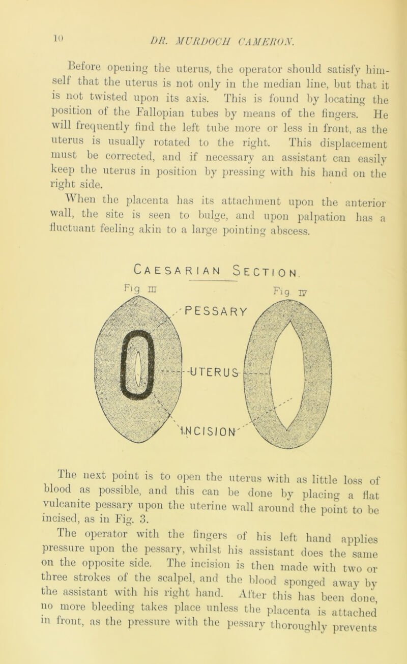 nil. Mill DOC}j CAMJMIOX. Jiefore opening the uterus, the operator should satisfy him- self that the uterus is not only in the median line, but that it is not twisted upon its axis. This is found by locating the position of the Fallopian tubes by means of the fingers. He will frequently find the left tube more or less in front, as the uterus is usually rotated to the right. This displacement must be corrected, and if necessary an assistant can easily keep the uterus in position by pressing with his hand on the right side. When the placenta has its attachment upon the anterior wall, the site is seen to bulge, and upon palpation has a fluctuant feeling akin to a large pointing abscess. Caesarian Section Fig nr ,-'PESSARY -UTERUS INCISION' The next point is to open the uterus with as little loss of blood as possible, and this can be done by placing a Hat vulcanite pessary upon the uterine wall around the pobit to be incised, as in Firt. 3. The operator with the fingers of his left hand applies pressure upon the pessary, whilst his assistant does the same on the opposite side. The incision is then made with two or three strokes of the scalpel, and the lilood sponged away by the assistant with his right hand. Alter this has been done no more bleeding takes jdace unless the placenta is attached m front, as the pressure with the pessary thoroughly prevents