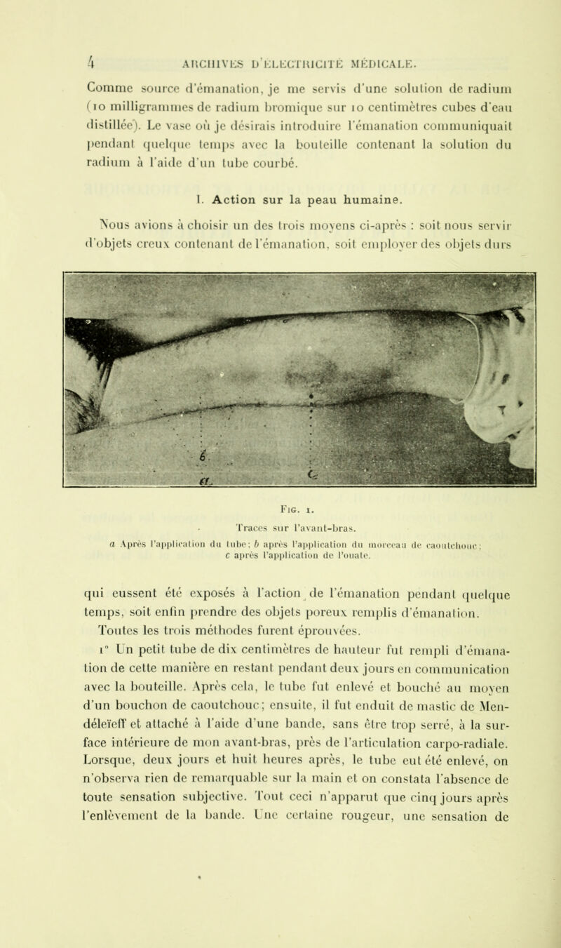 Comme source d’émanation, je me servis d’une solution de radium (io milligrammes de radium bromique sur 10 centimètres cubes d’eau distillée). Le vase où je désirais introduire l’émanation communiquait pendant quelque temps avec la bouteille contenant la solution du radium à l’aide d’un tube courbé. I. Action sur la peau humaine. Nous avions à choisir un des trois moyens ci-après : soit nous servir d’objets creux contenant de l’émanation, soit employer des objets durs Fig. i. Traces sur l’avant-bras. a Après l’application du tube; b après l’application du morceau de caoutchouc; C après l’application de l’ouate. qui eussent été exposés à l’action de l’émanation pendant quelque temps, soit enfin prendre des objets poreux remplis d’émanation. Toutes les trois méthodes furent éprouvées. i° Un petit tube de dix centimètres de hauteur fut rempli d émana- tion de cette manière en restant pendant deux jours en communication avec la bouteille. Après cela, le tube fut enlevé et bouché au moyen d’un bouchon de caoutchouc; ensuite, il fut enduit de mastic de Men- déleïeff et attaché à l’aide d’une bande, sans être trop serré, à la sur- face intérieure de mon avant-bras, près de l’articulation carpo-radiale. Lorsque, deux jours et huit heures après, le tube eut été enlevé, on n’observa rien de remarquable sur la main et on constata l’absence de toute sensation subjective. Tout ceci n’apparut que cinq jours après l’enlèvement de la bande. Une certaine rougeur, une sensation de