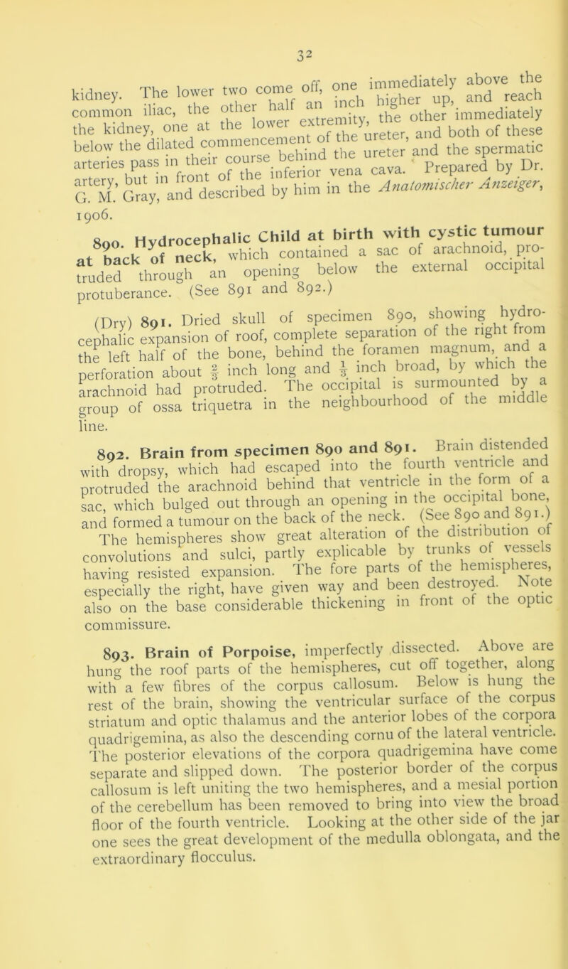 kidney. The lower two come oft Xf up! breach common iliac, the other a . . th°e other immediately the kidney, one at the lower ex f d 5oth Gf these below the the spernratic arteries pass m, their course, beh^ ^ ^ prepare(J by Dr G My.’ Gray, and described by him in the Anatom,scha- Anzeiger, 1906. 800 Hydrocephalic Child at birth with cystic tumour at back of neck, which contained a sac of arachnoid,. pre- ludedthrough an opening below the external occipital protuberance. (See 891 and 892.) (Dry) 801. Dried skull of specimen 890, showing hydro- cephalic expansion of roof, complete separation of the right from the left half of the bone, behind the foramen magnum and a perforation about § inch long and J inch broad, by which the arachnoid had protruded. The occipital is surmounted by a group of ossa triquetra in the neighbourhood of the middle line. 802. Brain from specimen 890 and 891. Brain distended with dropsy, which had escaped into the fourth ventricle and protruded the arachnoid behind that ventricle in the form of a sac, which bulged out through an opening in the occipital bone, and formed a tumour on the back of the neck, (bee 890 and 891.) The hemispheres show great alteration of the distribution of convolutions and sulci, partly explicable by trunks of vessels having resisted expansion. The fore parts of the hennsp ter , especially the right, have given way and been destroyed. Note also on the base considerable thickening in front ol the op 1 commissure. 893. Brain of Porpoise, imperfectly dissected. Above are hung the roof parts of the hemispheres, cut off together, along with a few fibres of the corpus callosum. Below is hung the rest of the brain, showing the ventricular surface of the corpus striatum and optic thalamus and the anterior lobes ot the corpora quadrigemina, as also the descending cornu of the lateral ventricle. The posterior elevations of the corpora quadrigemina have come separate and slipped down. The posterior border of the corpus callosum is left uniting the two hemispheres, and a mesial portion of the cerebellum has been removed to bring into view the broad floor of the fourth ventricle. Looking at the other side of the jar one sees the great development of the medulla oblongata, and the extraordinary flocculus.