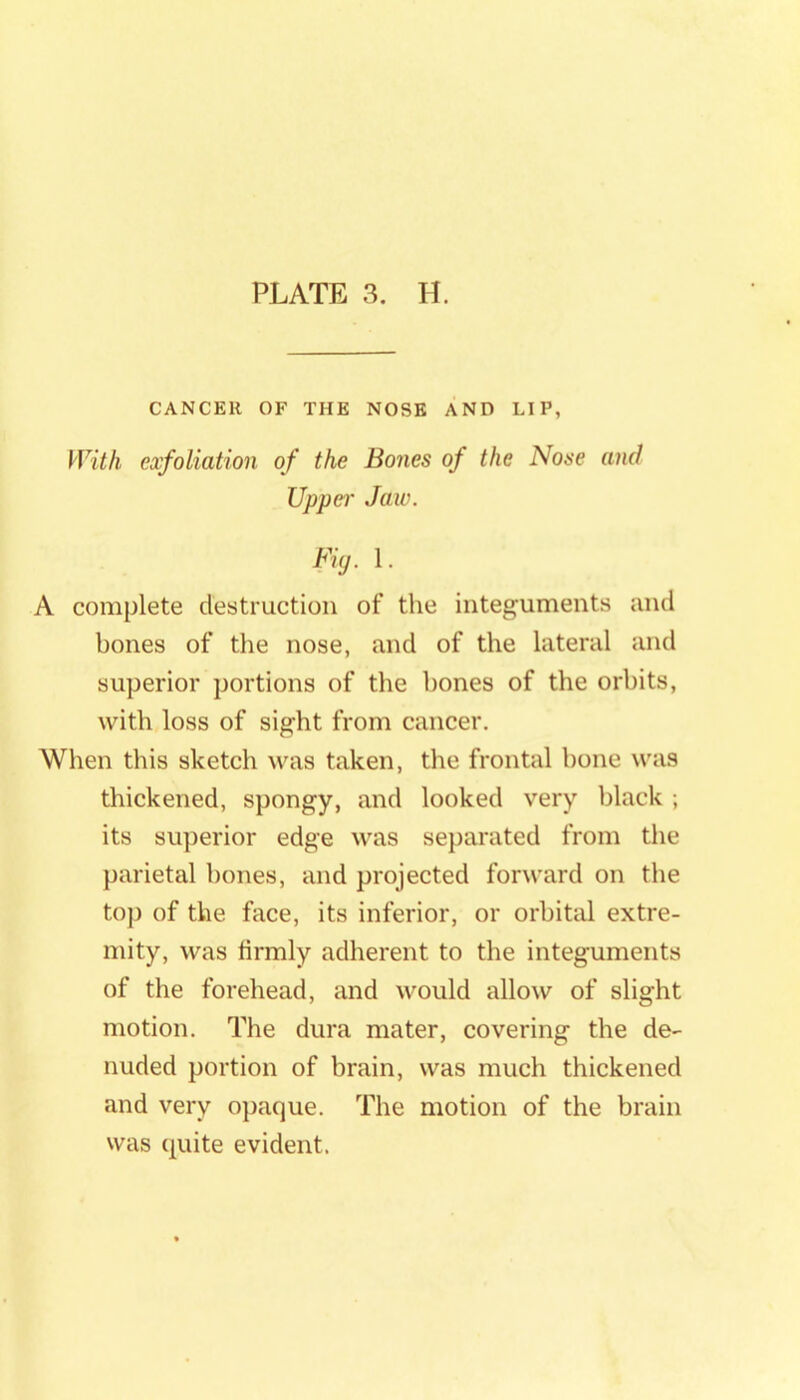 CANCER OF THE NOSE AND LIP, With exfoliation of the Bones of the Nose and Uppei' Jaw. Fiy. 1. A complete destruction of the integuments and bones of the nose, and of the lateral and superior portions of the hones of the orbits, with loss of sight from cancer. When this sketch was taken, the frontal bone was thickened, spongy, and looked very black ; its superior edge was separated from the parietal hones, and projected forward on the top of the face, its inferior, or orbital extre- mity, was firmly adherent to the integuments of the forehead, and would allow of slight motion. The dura mater, covering the de- nuded portion of brain, was much thickened and very opaque. The motion of the brain was quite evident.