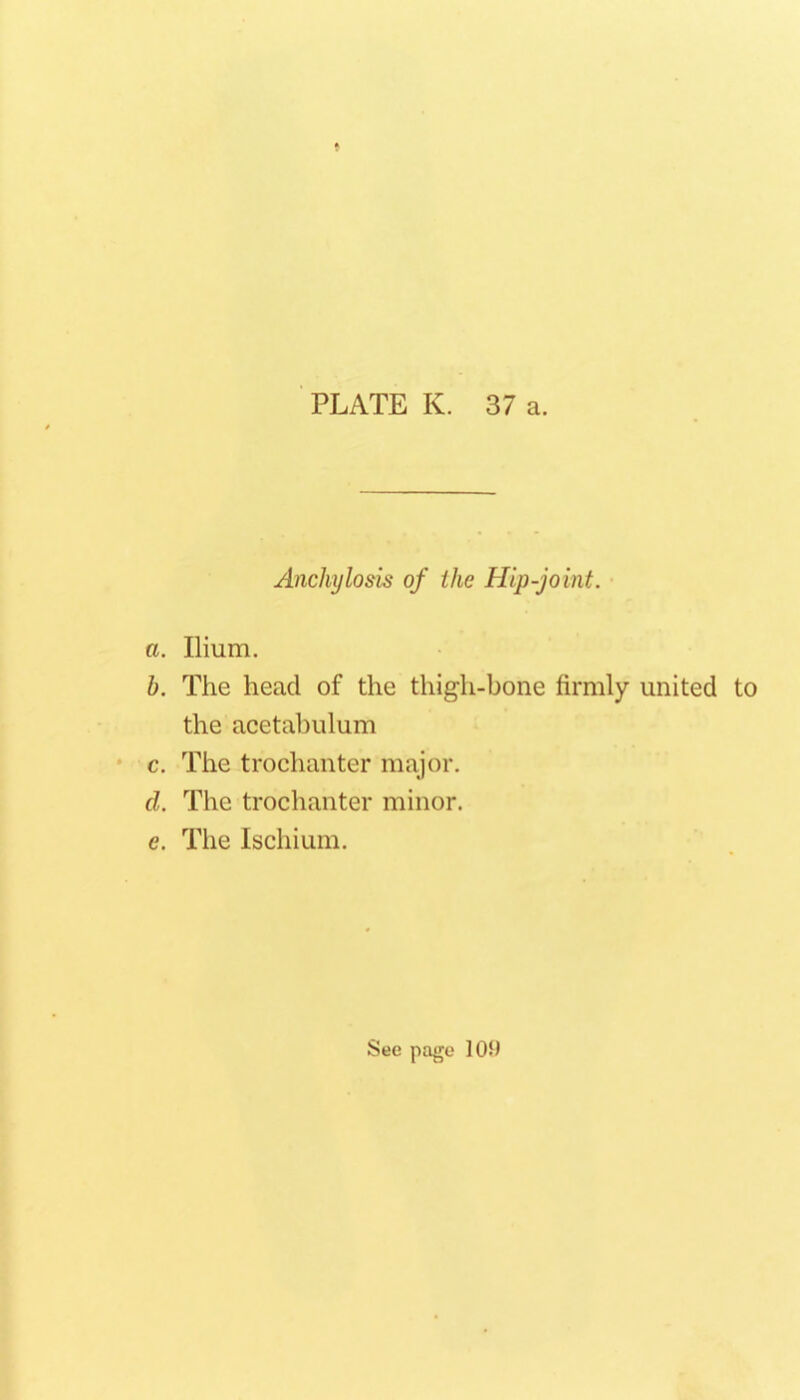 Anchylosis of the Hip-joint. ■ a. Ilium. b. The head of the thigh-bone firmly united to the acetabulum • c. The trochanter major. d. The trochanter minor. e. The Ischium.