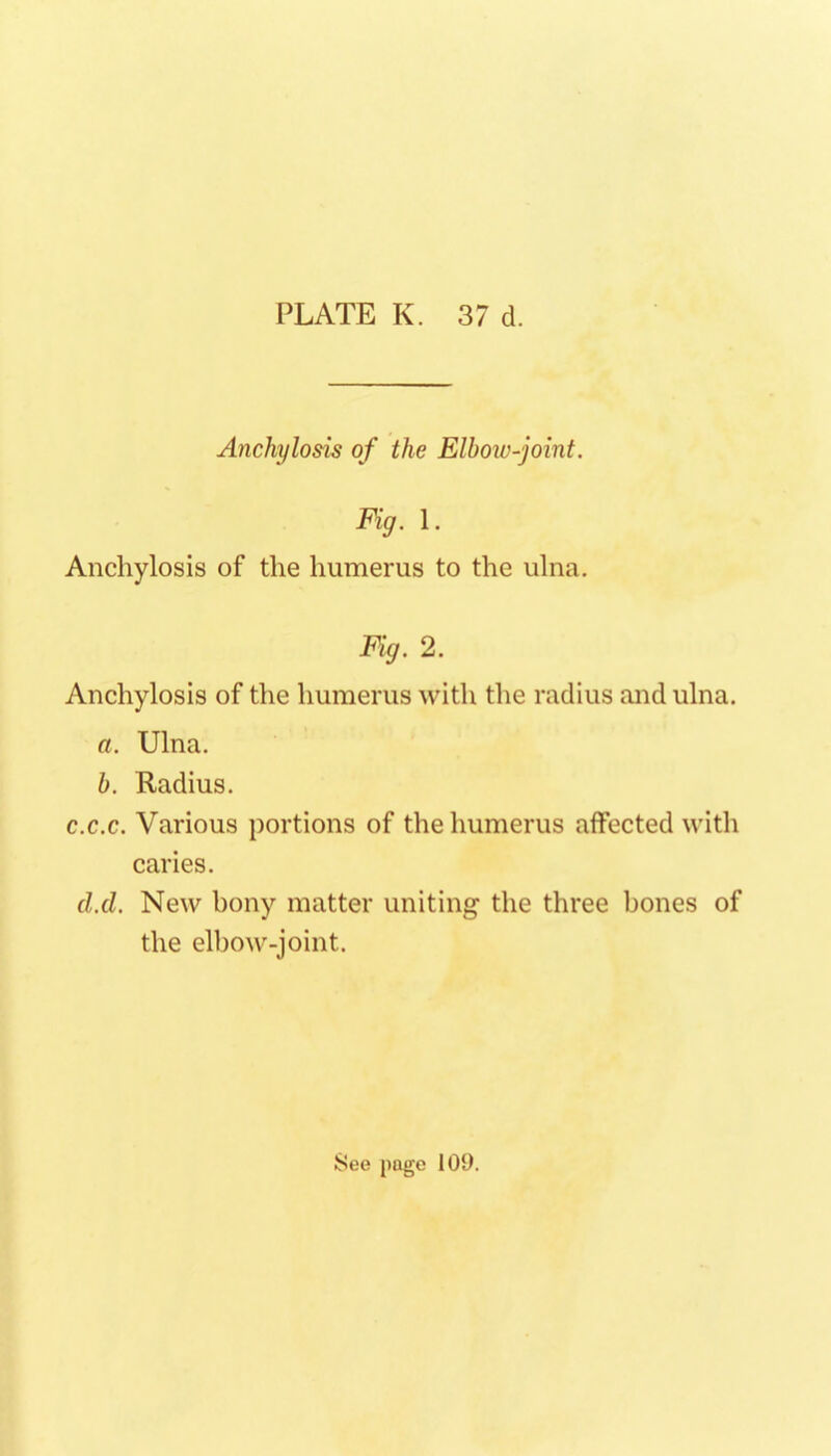 Anchylosis of the Elboiv-joint. Fig. 1. Anchylosis of the humerus to the ulna. Fig. 2. Anchylosis of the humerus with the radius and ulna. a. Ulna. b. Radius. c.c.c. Various portions of the humerus affected with caries. d.d. New bony matter uniting the three bones of the elbow-joint.