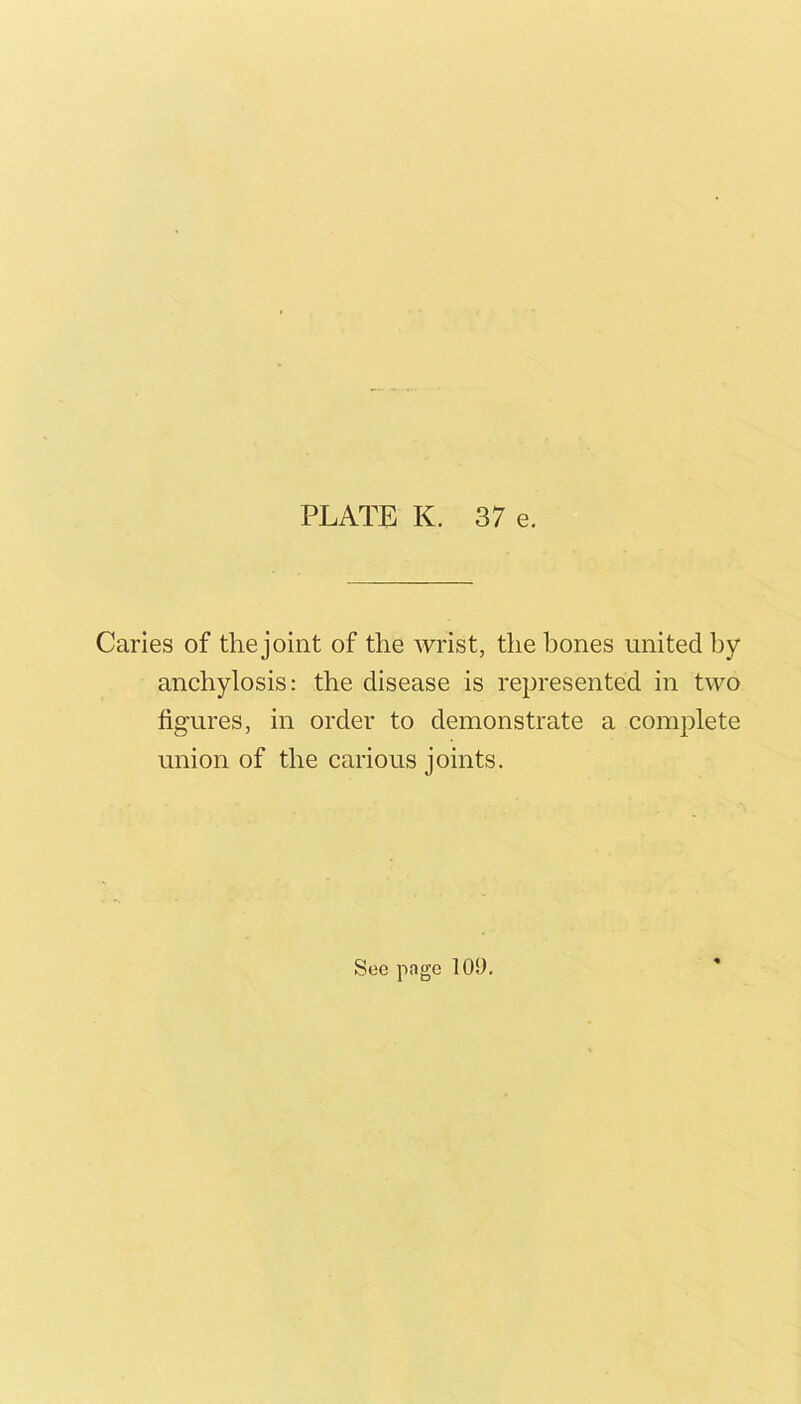 Caries of the joint of the wrist, the hones united by anchylosis: the disease is represented in two figures, in order to demonstrate a complete union of the carious joints.
