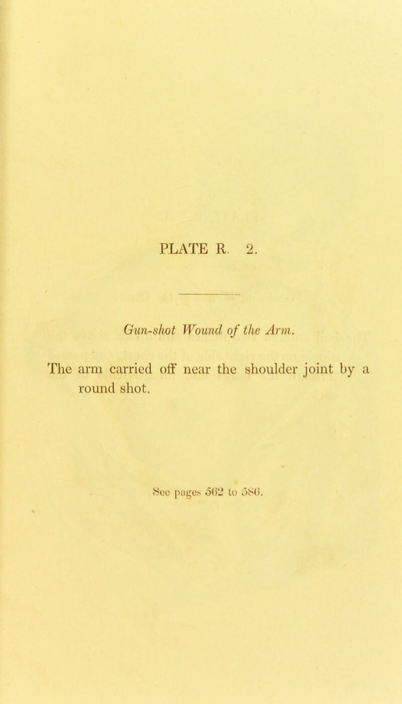 Gun-shot Wound of the Ann. The arm carried off near the shoulder joint by a round shot. pugcfi o()li to 58().