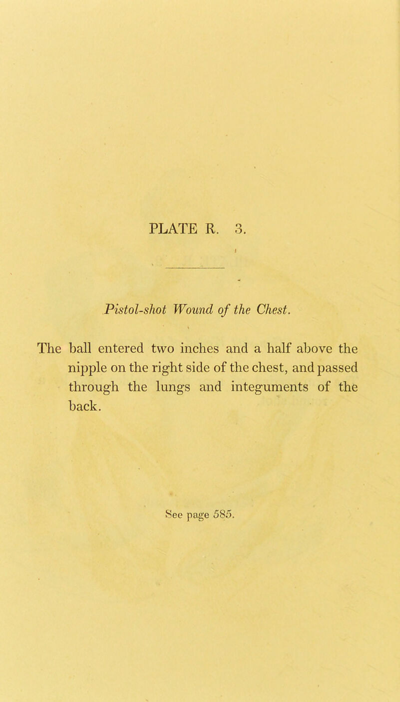 Pistol-shot Wound of the Chest. The ball entered two inches and a half above the nipple on the right side of the chest, and passed through the lungs and integuments of the hack. .See page 585.