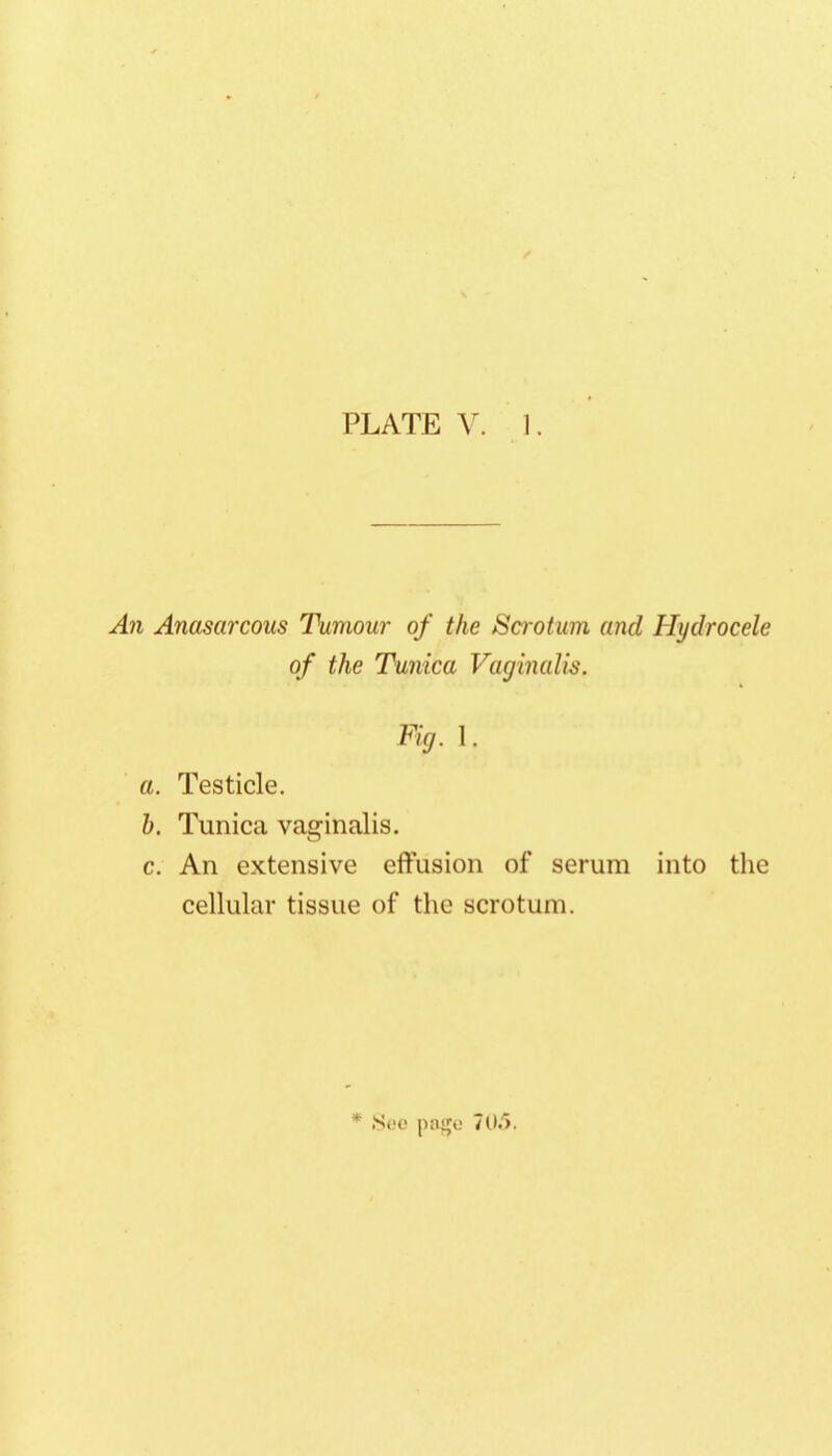 A?i Anasarcous Tumour of the Scrotum and Hydrocele of the Tunica Vaginalis. Fig. 1. a. Testicle. h. Tunica vaginalis. c. An extensive effusion of serum into the cellular tissue of the scrotum. * .Soc [niiju 7U.').