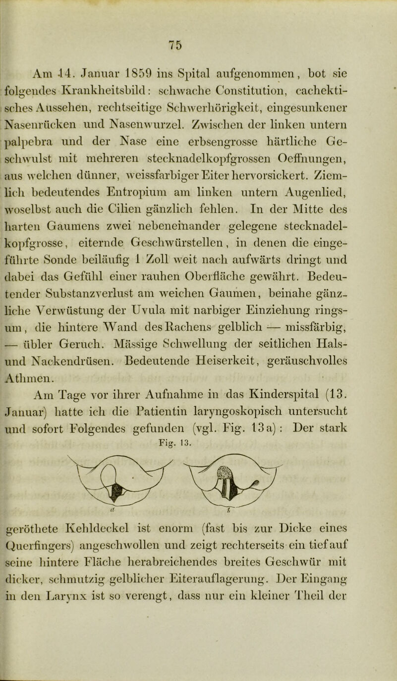 Am .14. Januar 1859 ins Spital aufgenommen, bot sie folgendes Kranklieitsbild: schwache Constitution, cachekti- sches Aussehen, rechtseitige Schwerhörigkeit, eingesunkener Nasenrücken und Nasenwurzel. Zwischen der linken untern palpebra und der Nase eine erbsengrosse härtliche Ge- schwulst mit mehreren stecknadelkopfgrossen Ocffnungen, aus welchen dünner, weissfarbiger Eiter hervorsickert. Ziem- lich bedeutendes Entropium am linken untern Augenlied, woselbst auch die Cilien gänzlich fehlen. In der Mitte des harten Gaumens zwei nebeneinander gelegene Stecknadel- kopfg rosse, eiternde Geschwürstellen, in denen die einge- führte Sonde beiläufig 1 Zoll weit nach aufwärts dringt und dabei das Gefühl einer rauhen Oberfläche gewährt. Bedeu- tender Substanzverlust am weichen Gaumen, beinahe gänz- liche Verwüstung der Uvula mit narbiger Einziehung rings- um, die hintere Wand des Hachens gelblich -— missfärbig, — übler Geruch. Massige Schwellung der seitlichen Hais- und Nackendrüsen. Bedeutende Heiserkeit, geräuschvolles Atlnnen. Am Tage vor ihrer Aufnahme in das Kinderspital (13. Januar) hatte ich die Patientin laryngoskopisch untersucht und sofort Folgendes gefunden (vgl. Fig. 13a): Der stark Fig. 13. gerötliete Kehldeckel ist enorm (fast bis zur Dicke eines Querfingers) angeschwollen und zeigt rechterseits ein tief auf seine hintere Fläche herabreichendes breites Geschwür mit dicker, schmutzig gelblicher Eiterauflagerung. Der Eingang in den Larynx ist so verengt, dass nur ein kleiner Theil der