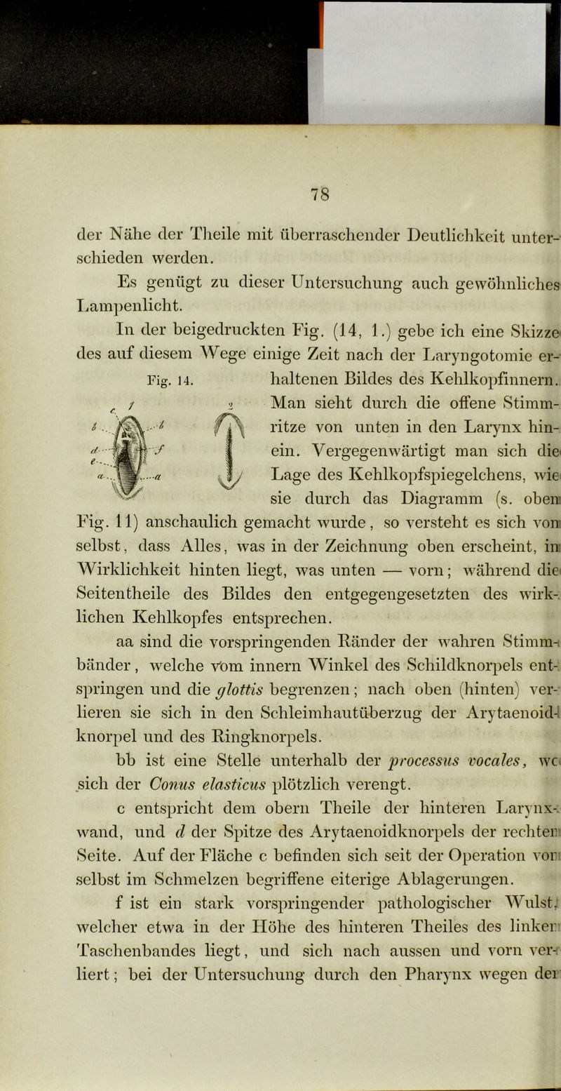 Fig. 14. der Nähe der Theile mit überraschender Deutlichkeit unter- schieden werden. Es genügt zu dieser Untersuchung auch gewöhnliches Lampenlicht. In der beigedruckten Fig. (14, 1.) gebe ich eine Skizze des auf diesem Wege einige Zeit nach der Laryngotomie er- haltenen Bildes des Kehlkopfinnem. Man sieht durch die offene Stimm- ritze von unten in den Larynx hin- ein. Vergegenwärtigt man sich die Lage des Kehlkopfspiegelchens, wie sie durch das Diagramm (s. oben Fig. 11) anschaulich gemacht wurde, so versteht es sich von selbst, dass Alles, was in der Zeichnung oben erscheint, in Wirklichkeit hinten liegt, was unten — vorn; während die Seitentheile des Bildes den entgegengesetzten des wirk- lichen Kehlkopfes entsprechen. aa sind die vorspringenden Bänder der wahren Stimm- bänder , welche Vom innern Winkel des Schildknorpels ent- springen und die glottis begrenzen; nach oben (hinten) ver- lieren sie sich in den Schleimhaut Überzug der Arytaenoid- knorpel und des Bingknorpels. bb ist eine Stelle unterhalb der processus vocales, wc sich der Conus elasticus plötzlich verengt. c entspricht dem obern Theile der hinteren Larynx-; wand, und cl der Spitze des Arytaenoidknorpels der rechten Seite. Auf der Fläche c befinden sich seit der Operation vor selbst im Schmelzen begriffene eiterige Ablagerungen. f ist ein stark vorspringender pathologischer Wulst; welcher etwa in der Flöhe des hinteren Theiles des linker Taschenbandes liegt, und sich nach aussen und vorn ver- liert ; bei der Untersuchung durch den Pharynx wegen dei
