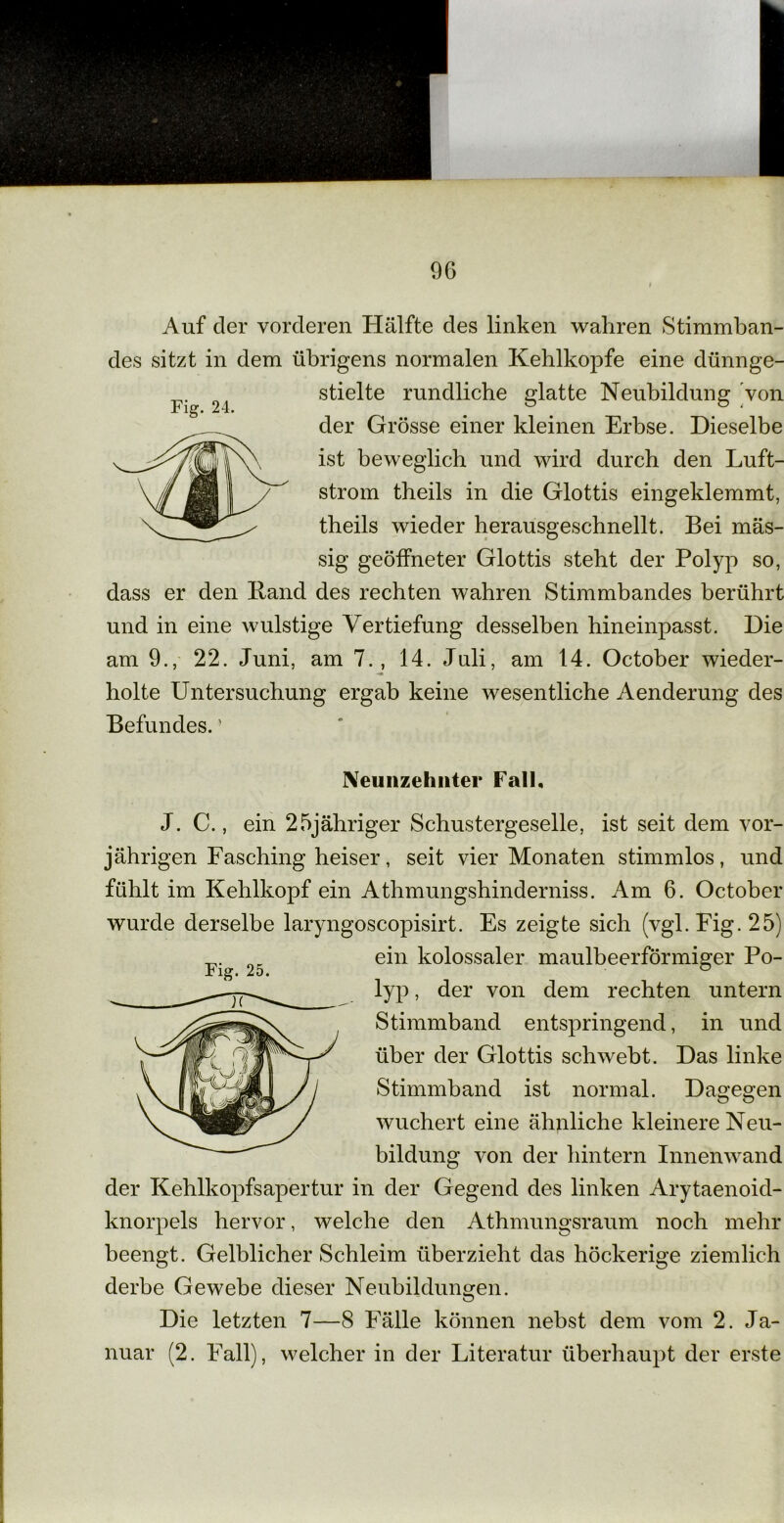 Auf der vorderen Hälfte des linken wahren Stimmban- des sitzt in dem übrigens normalen Kehlkopfe eine dünnge- F. 21 stielte rundliche glatte Neubildung von der Grösse einer kleinen Erbse. Dieselbe ist beweglich und wird durch den Luft- strom tbeils in die Glottis eingeklemmt, tbeils wieder herausgeschnellt. Bei mas- sig geöffneter Glottis steht der Polyp so, dass er den Band des rechten wahren Stimmbandes berührt und in eine wulstige Vertiefung desselben hineinpasst. Die am 9., 22. Juni, am 7., 14. Juli, am 14. October wieder- holte Untersuchung ergab keine wesentliche Aenderung des Befundes. ’ Neunzehnter Fall, J. C., ein 25jähriger Schustergeselle, ist seit dem vor- jährigen Fasching heiser, seit vier Monaten stimmlos, und fühlt im Kehlkopf ein Athmungshinderniss. Am 6. October wurde derselbe laryngoscopisirt. Es zeigte sich (vgl. Fig. 25) 25 ein kolossaler maulbeerförmiger Po- lyp , der von dem rechten untern Stimmband entspringend, in und über der Glottis schwebt. Das linke Stimmband ist normal. Dagegen wuchert eine ähnliche kleinere Neu- bildung von der hintern Innenwand der Kehlkopfsapertur in der Gegend des linken Arytaenoid- knorpels hervor, welche den Athmungsraum noch mehr beengt. Gelblicher Schleim überzieht das höckerige ziemlich derbe Gewebe dieser Neubildungen. Die letzten 7—8 Fälle können nebst dem vom 2. Ja- nuar (2. Fall), welcher in der Literatur überhaupt der erste