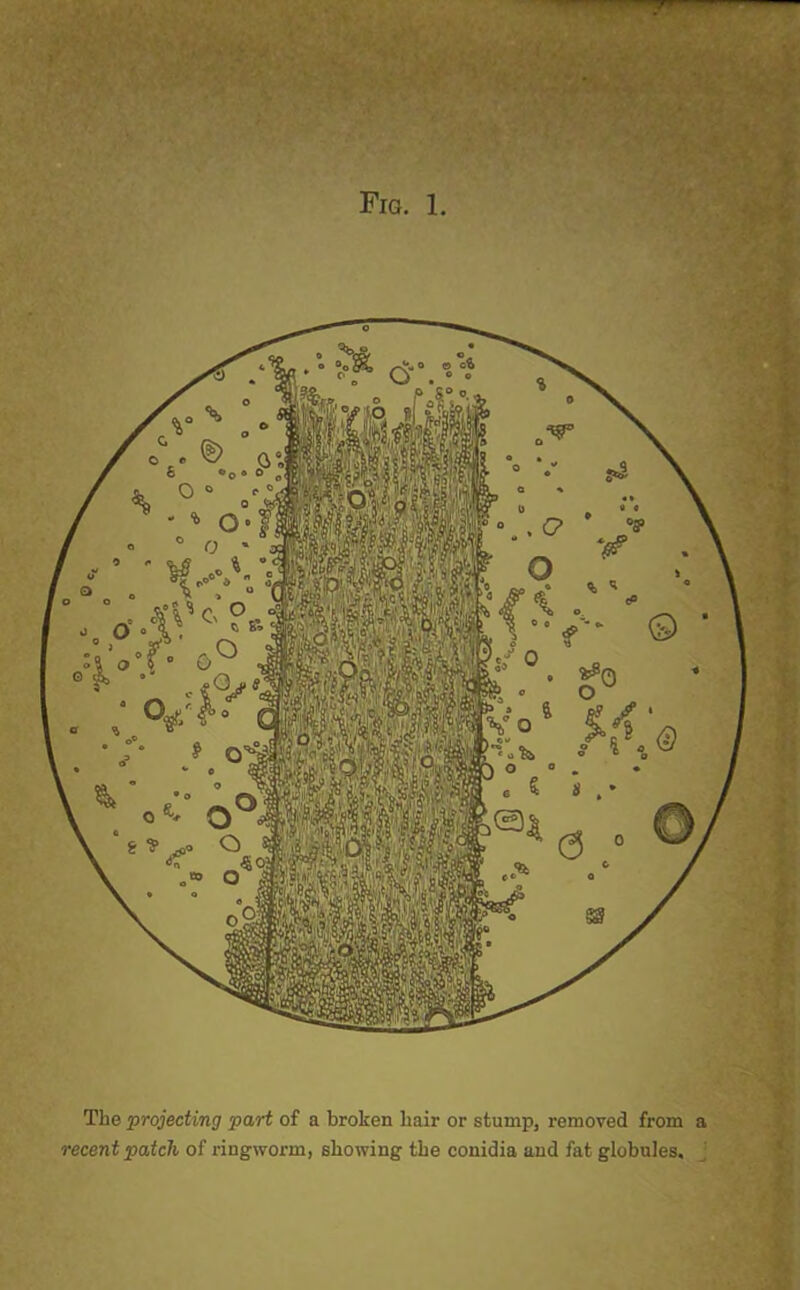 The projecting part of a broken hair or stump, removed from a recent patch of ringworm, showing the conidia and fat globules.