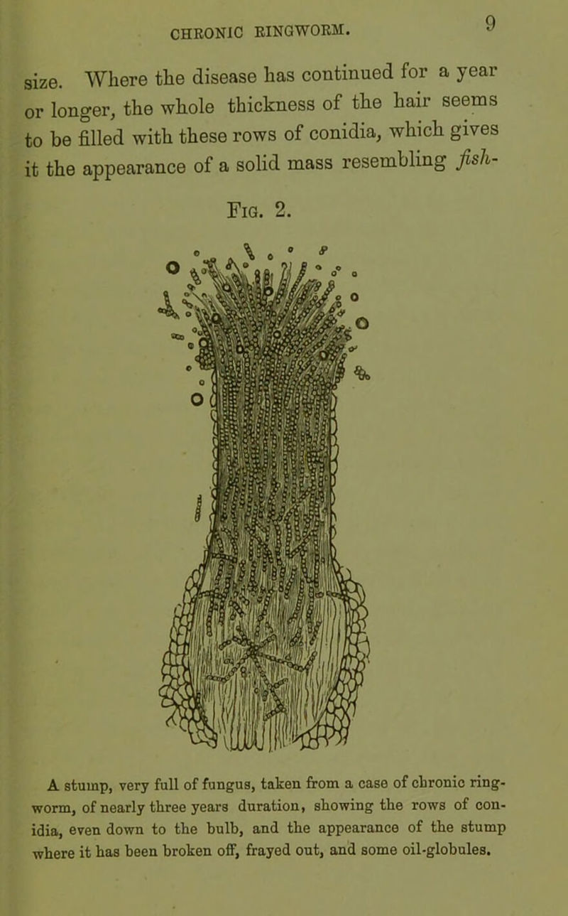 CHRONIC RINGWORM. size. Where the disease has continued for a year or longer, the whole thickness of the hair seems to be filled with these rows of conidia, which gives it the appearance of a solid mass resembling fisli- Fig. 2. A stump, very full of fungus, taken from a case of chronic ring- worm, of nearly three years duration, showing the rows of con- idia, even down to the bulb, and the appearance of the stump where it has been broken off, frayed out, and some oil-globules.