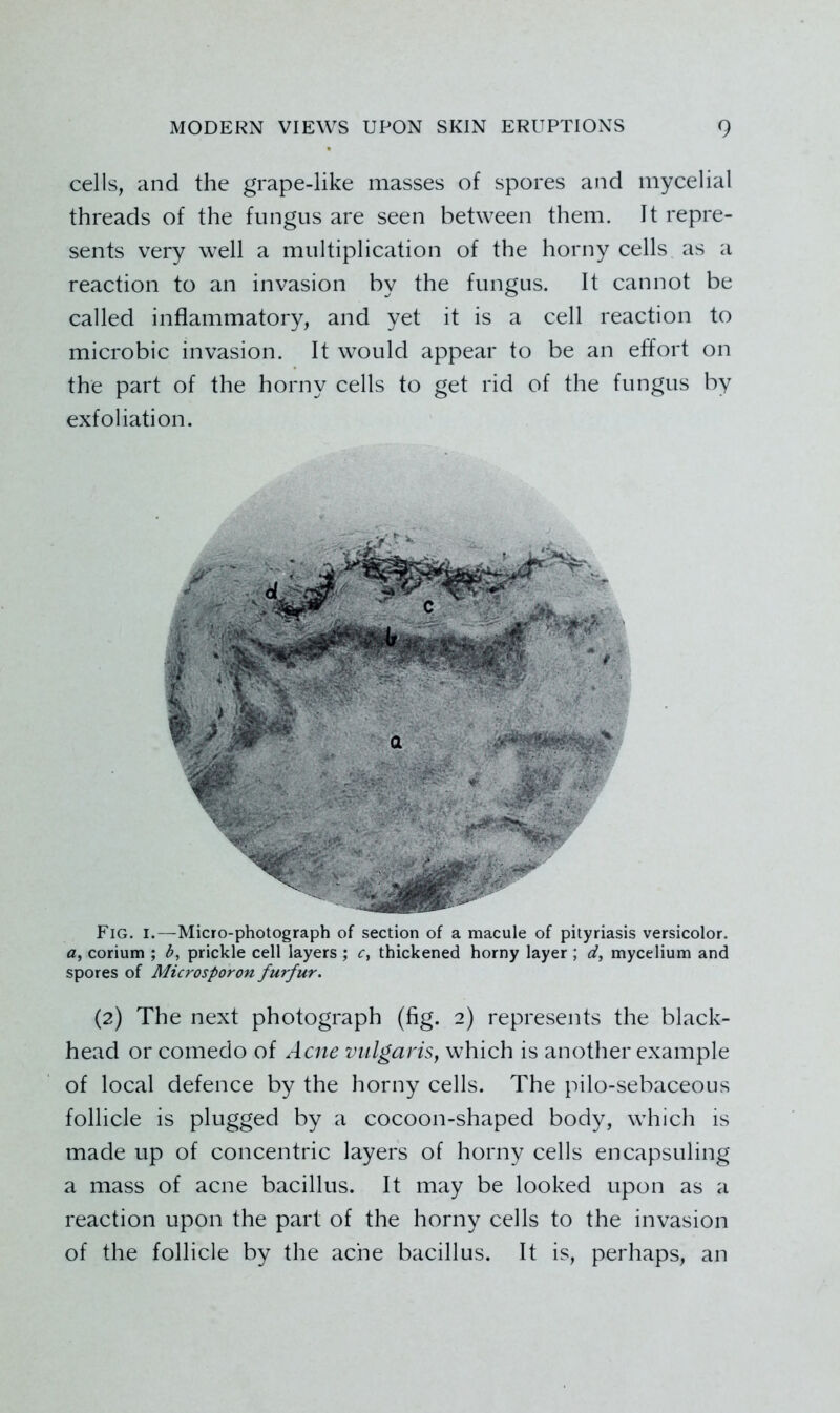 cells, and the grape-like masses of spores and mycelial threads of the fungus are seen between them. It repre- sents very well a multiplication of the horny cells as a reaction to an invasion by the fungus. It cannot be called inflammatory, and yet it is a cell reaction to microbic invasion. It would appear to be an effort on the part of the horny cells to get rid of the fungus by exfoliation. Fig. I.—Micro-photograph of section of a macule of pityriasis versicolor, fl, corium ; prickle cell layers ; thickened horny layer ; mycelium and spores of Microsporon furfur. (2) The next photograph (fig. 2) represents the black- head or comedo of Acne vulgaris, which is another example of local defence by the horny cells. The pilo-sebaceous follicle is plugged by a cocoon-shaped body, which is made up of concentric layers of horny cells encapsuling a mass of acne bacillus. It may be looked upon as a reaction upon the part of the horny cells to the invasion of the follicle by the ache bacillus. It is, perhaps, an