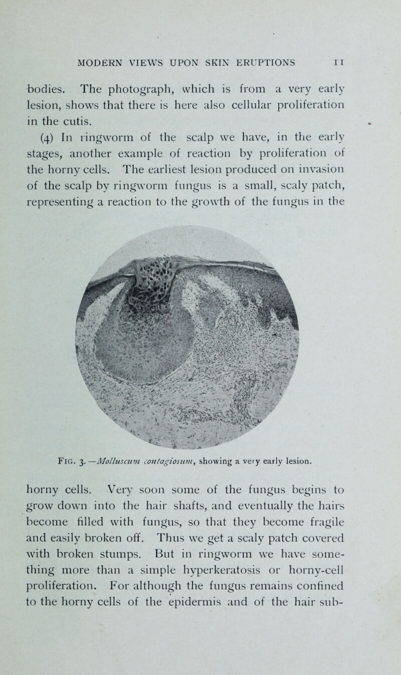 bodies. The photograph, which is from a very early lesion, shows that there is here also cellular proliferation in the cutis. (4) In ringworm of the scalp we have, in the early stages, another example of reaction by proliferation of the horny cells. The earliest lesion produced on invasion of the scalp by ringworm fungus is a small, scaly patch, representing a reaction to the growth of the fungus in the Fig. 3.—Molluscum contagiosuvi, showing a very early lesion. horny cells. Very soon some of the fungus begins to grow down into the hair shafts, and eventually the hairs become filled with fungus, so that they become fragile and easily broken off. Thus we get a scaly patch covered with broken stumps. But in ringworm we have some- thing more than a simple hyperkeratosis or horny-cell proliferation. For although the fungus remains confined to the horny cells of the epidermis and of the hair sub-