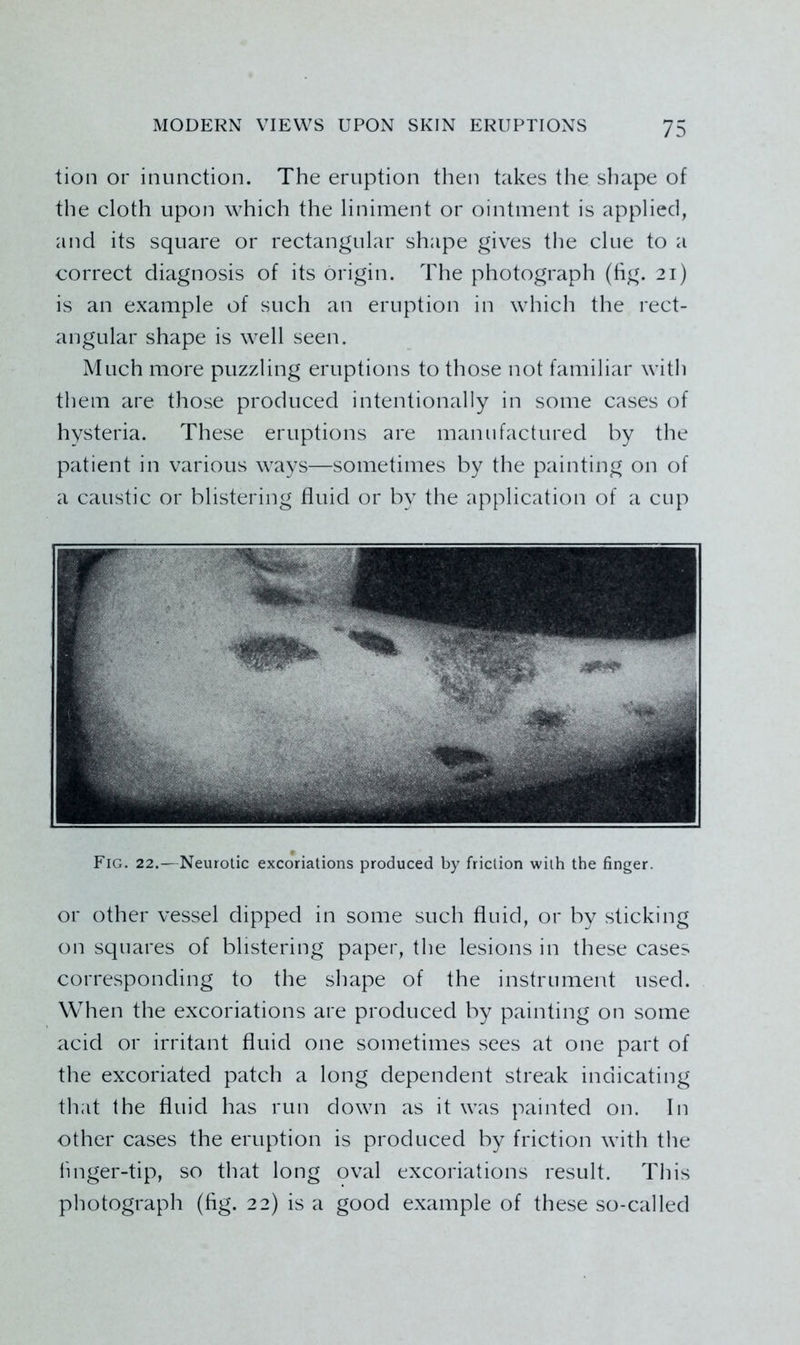 tion or inunction. The eruption then takes the shape of the cloth upon which the liniment or ointment is applied, and its square or rectangular shape gives the clue to a correct diagnosis of its origin. The photograph (fig. 21) is an example of such an eruption in which the rect- angular shape is well seen. Much more puzzling eruptions to those not familiar with them are those produced intentionally in some cases of hysteria. These eruptions are manufactured by the patient in various ways—sometimes by the painting on of a caustic or blistering fluid or by the application of a cup Fig. 22.—Neurotic excoriations produced by friction with the finger. or other vessel dipped in some such fluid, or by sticking on sqtiares of blistering paper, the lesions in these cases corresponding to the shape of the instrument used. When the excoriations are produced by painting on some acid or irritant fluid one sometimes sees at one part of the excoriated patch a long dependent streak indicating that the fluid has run down as it was painted on. In other cases the eruption is produced by friction with the finger-tip, so that long oval excoriations result. This photograph (fig. 22) is a good example of these so-called