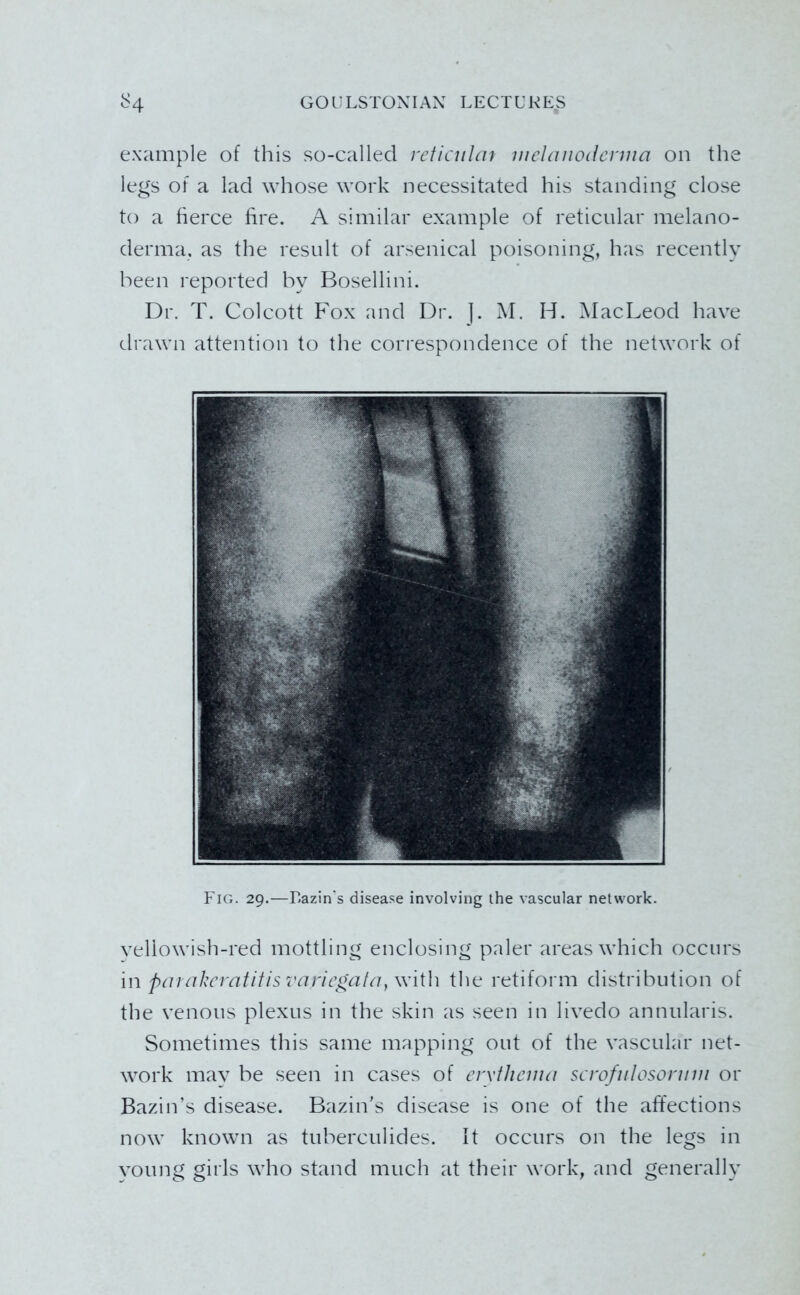 example of this so-called reticulm melmiodenua on the legs of a lad whose work necessitated his standing close to a fierce hre. A similar example of reticular melano- derma. as the result of arsenical poisoning, has recently been reported by Bosellini. Dr. T. Colcott Fox and Dr. ]. M. H. iMacLeod have drawn attention to the cori'espondence of the network of Fig. 29.—r.azin's disease involving the vascular network. veliowish-red mottling enclosing paler areas which occurs in pai ahcvatitis varic^ata,w\\\\ the retiform distribution of the venous plexus in the skin as seen in livedo annularis. Sometimes this same mapping out of the vascular net- work may be seen in cases of erythema serofiilosoriim or Bazin’s disease. Bazin’s disease is one of the affections now known as tuberculides. It occurs on the legs in young girls who stand much at their work, and generally