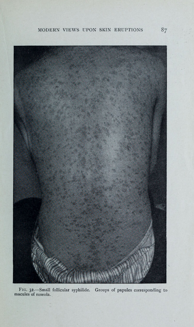 Fig. 32.—Small follicular syphilide. Groups of papules corresponding to macules of roseola.