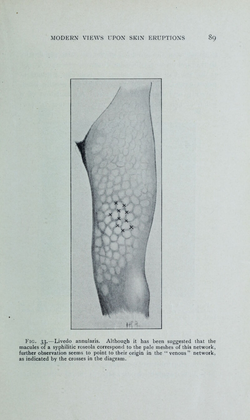 Fig. 33.—Livedo annularis. Althouijh it has been suggested that the macules of a syphilitic roseola correspond to the pale meshes of this network, further observation seems to point to their origin in the “venous” network, as indicated by the crosses in the diagram.