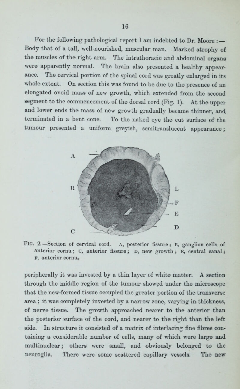 For the following pathological report I am indebted to Dr. Moore : — Body that of a tall, well-nourished, muscular man. Marked atrophy of the muscles of the right arm. The intrathoracic and abdominal organs were apparently normal. The brain also presented a healthy appear- ance. The cervical portion of the spinal cord was greatly enlarged in its whole extent. On section this was found to be due to the presence of an elongated ovoid mass of new growth, which extended from the second segment to the commencement of the dorsal cord (Fig. 1). At the upper and lower ends the mass of new growth gradually became thinner, and terminated in a bent cone. To the naked eye the cut surface of the tumour presented a uniform greyish, semitranslucent appearance; Fig. 2.—Section of cervical cord. A, posterior fissure; b, ganglion cells of anterior cornu; C, anterior fissure; D, new growth ; E, central canal; F, anterior cornu. peripherally it was invested by a thin layer of white matter. A section through the middle region of the tumour showed under the microscope that the new-formed tissue occupied the greater portion of the transverse area; it was completely invested by a narrow zone, varying in thickness, of nerve tissue. The growth approached nearer to the anterior than the posterior surface of the cord, and nearer to the right than the left side. In structure it consisted of a matrix of interlacing fine fibres con- taining a considerable number of cells, many of which were large and multinuclear; others were small, and obviously belonged to the neuroglia. There were some scattered capillary vessels. The new