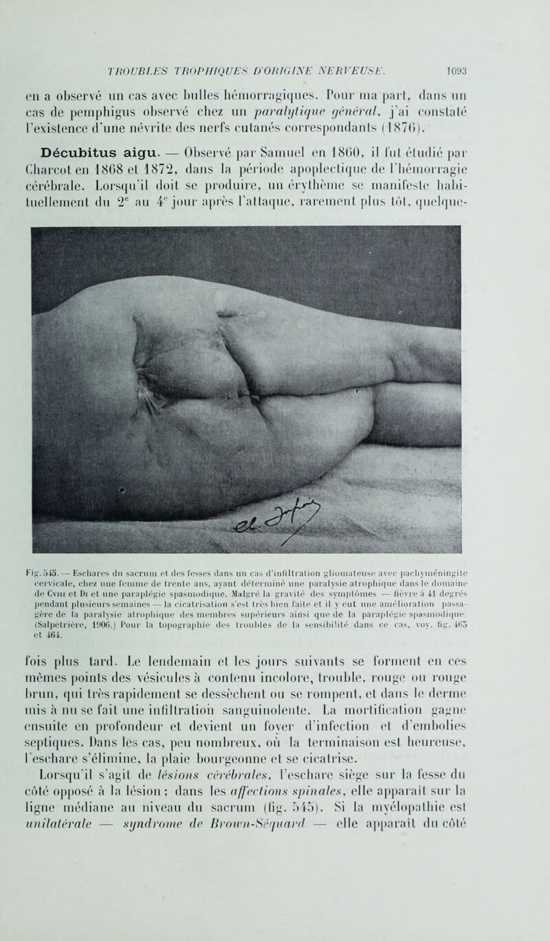 eu a observé un cas avec bulles hémorragiques. Pour ma part, dans un cas de pemphigus observé chez un paralytique général, j'ai constaté l'existence d’une névrite des nerfs cutanés correspondants ( 1876). Décubitus aigu. — Observé par Samuel en 1860, il fut étudié par Charcot en 1868 et 1872, dans la période apoplectique de l'hémorragie cérébrale. Lorsqu'il doit se produire, un érythème se manifeste habi- tuellement du 2e au 4e jour après l’attaque, rarement plus tôt, quelquc- Fig.545.— Eschares du sacrum et des fesses dans un cas d’inliltration gliomaleuso avec pachyinéningite cervicale, chez une femme de trente ans, ayant déterminé une paralysie atrophique dans le domaine de Cviii et Di et une paraplégie spasmodique. Malgré la gravité des symptômes — fièvre à 41 degrés pendant plusieurs semaines — la cicatrisation s’est très bien faite et il y eut une amélioration passa- gère de la paralysie atrophique des membres supérieurs ainsi que de la paraplégie spasmodique (Salpétrière, 100*5.) Pour la topographie des troubles de la sensibilité dans ce cas, voy. lig. 463 et 464. fois plus tard. Le lendemain et les jours suivants se forment en ces mêmes points des vésicules à contenu incolore, trouble, rouge ou rouge brun, qui très rapidement se dessèchent ou se rompent, et dans le derme mis à nu se fait une infiltration sanguinolente. La mortification gagne ensuite en profondeur et devient un foyer d’infection et d’embolies septiques. Dans les cas, peu nombreux, où la terminaison est heureuse, l’eschare s’élimine, la plaie bourgeonne et se cicatrise. Lorsqu’il s’agit de lésions cérébrales, l’eschare siège sur la fesse du côté opposé à la lésion; dans les affections spinales, elle apparaît sur la ligne médiane an niveau du sacrum (lig. 545). Si la myélopathie est unilatérale — syndrome de Brown-Séquard. — elle apparaît du côté