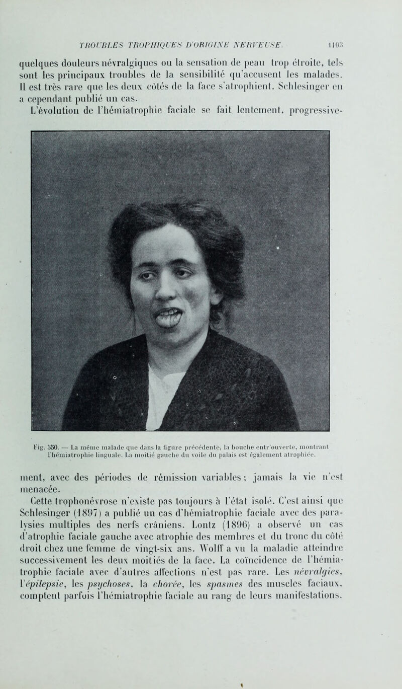 quelques douleurs névralgiques ou la sensation de peau trop étroite, tels sont les principaux troubles de la sensibilité qu’accusent les malades. Il est très rare que les deux côtés de la face s’atrophient. Schlesinger en a cependant publié un cas. L’évolution de l’hémiatrophie faciale se fait lentement, progressive- Fig. 550. — La même malade que dans la ligure précédente-, la bouche entr’ouverte, montrant riiémiatrophie linguale. La moitié gauche du voile du palais est également atrophiée. ment, avec des périodes de rémission variables ; jamais la vie n'est menacée. Cette trophonévrose n’existe pas toujours à l’état isolé. C’est ainsi que Schlesinger (1897) a publié un cas d’hémiatrophie faciale avec des para- lysies multiples des nerfs crâniens. Lonlz (1890) a observé un cas d’atrophie faciale gauche avec atrophie des membres et du tronc du côté droit chez une femme de vingt-six ans. Wolff a vu la maladie atteindre successivement les deux moitiés de la face. La coïncidence de l’hémia- trophie faciale avec d’autres affections n’est pas rare. Les névralgies, Yépilepsie, les psychoses, la chorée, les spasmes des muscles faciaux, comptent parfois l’hémiatrophie faciale au rang de leurs manifestations.