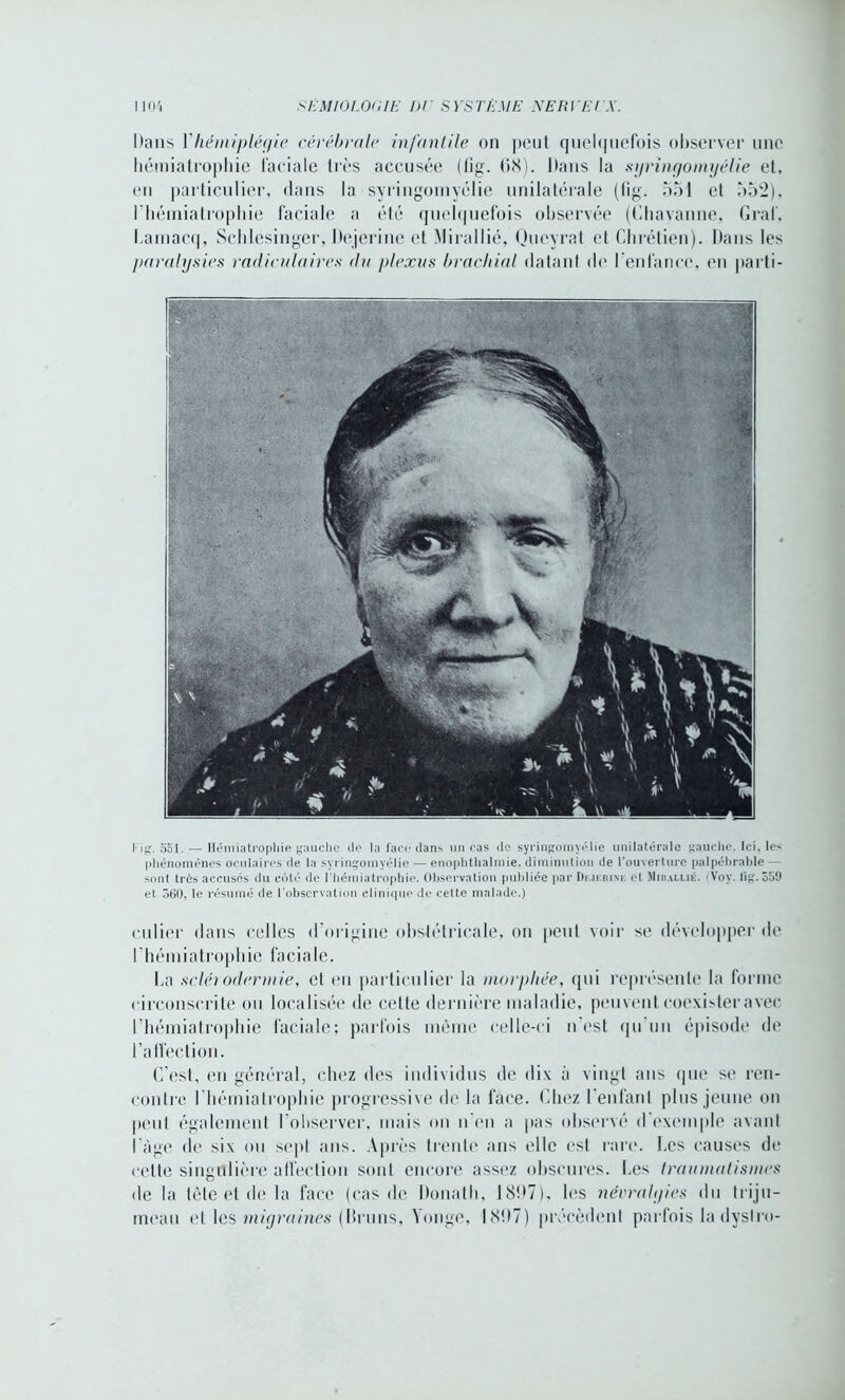 Dans Y hémiplégie cérébrale infantile on peut quelquefois observer une liémiatrophie faciale très accusée (lîg. 08). Dans la syringoinyélie et, en particulier, dans la syringoinyélie unilatérale (fig. bol et 552), riiémiatrophie faciale a été quelquefois observée (Chavanne, Graf, Lainacq, Schlesinger, Dejerine et Mirallié, Queyrat et Chrétien). Dans les paralysies radiculaires du plexus brachial datant de l'enfance, en parti- 1 ig. 551. — liémiatrophie gauche de la face dans un cas do syringoinyélie unilatérale gauche. Ici, les phénomènes oculaires de la syringoinyélie — enophthalmie, diminution de l’ouverture palpébrable — sont très accusés du côté de l’Iiémiatrophie. Observation publiée par Dkjerini: el Miralluc. (Voy. lig. 359 et 560, le résumé de l’observation clinique de celte malade.) culier dans celles d’origine obstétricale, on peut voir sc développer de riiémiatrophie faciale. La sclérodermie, el eu particulier la nwrpliée, qui représente la forme circonscrite ou localisée de celte dernière maladie, peuvent coexister avec riiémiatrophie faciale; parfois même celle-ci n’est qu un épisode de l'affection. C’est, en général, chez des individus de dix à vingt ans que se ren- contre l’hémialrophie progressive de la face. Chez l’enfant plus jeune on peut également l’observer, mais on n'en a pas observé d exemple avant I âge de six ou sep! ans. Après trente ans elle esl rare. Les causes de celte singulière affection sont encore assez obscures. Les traumatismes de la tête et de la face (cas de Donatli, 1897), les névralyies du triju- meau et les migraines (bruns, Yonge, 1897) précèdent parfois la dyslro-