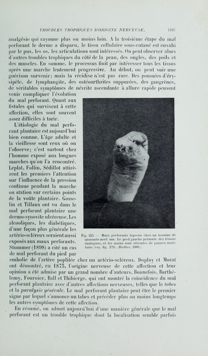 analgésie qui rayonne plus ou moins loin. A la troisième étape du mal perforant le derme a disparu, le tissu cellulaire sous-cutané est envahi par le pus. les os, les articulations sont intéressés. <>n peut observer alors d’autres troubles trophiques du côté de la peau, des ongles, des poils cl des muscles. En somme, le processus finit par intéresser tous les tissus après une marche lentement progressive. Au début, on peut voir une guérison survenir; mais la récidive n’est pas rare. Des poussées d’éry- sipèle, de lymphangite, des ostéoarthrites suppurées, des gangrènes, de véritables symptômes de névrite ascendanle à allure rapide peuvent venir compliquer l’évolution du mal perforant. Quant aux fistules qui survivent à cette affection, elles sont souvent assez difficiles à tarir. L’étiologie du mal perfo- rant plantaire est aujourd’hui bien connue. L’àge adulte et la vieillesse sont ceux où on l’observe; c’est surtout chez l’homme exposé aux longues marches qu’on l’a rencontré. Leplat, Follin, Sédillot attirè- rent les premiers l’attention sur l'influence de la pression continue pendant la marche ou station sur certains points de la voûte plantaire. Gosse- lin et Tillaux ont vu dans le mal perforant plantaire une dermo-synovite ulcéreuse. Les alcooliques, les diabétiques, d’une façon plus générale les artério-scléreux seraient aussi exposés aux maux perforants. Stummer (1898) a cité un cas de mal perforant du pied par embolie de l’artère poplitée chez un artério-scléreux. Duplay et Moral ont démontré, en 1873, l’origine nerveuse de cette affection et leur opinion a été admise par un grand nombre d’auteurs, Bonnefois, Barthé- lemy, Fournier, Bail et Thibierge, qui ont montré la coïncidence du mal perforant plantaire avec d’autres affections nerveuses, telles que le tabes et la paralysie générale. Le mal perforant plantaire peut être le premier signe par lequel s’annonce un tabes et précéder plus ou moins longtemps les autres symptômes de cette affection. En résumé, on admet aujourd’hui d’une manière générale que le mal perforant est un trouble trophique dont la localisation semble parfois Fig. 553. — Maux perforants lépreux chez un homme de quarante-neuf ans. Le pied gauche présente des lésions analogues, et les mains sont atteintes de panaris muti- lants (voy. fig. 179). (Bicêtre, 1889.)