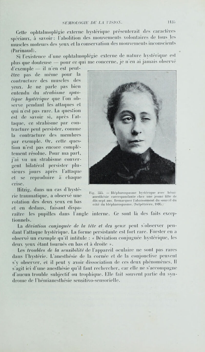Cette ophtalmoplégie externe hvstéri(|ue présenteraiI des caractères spéciaux, à savoir: l’abolition des mouvements volontaires de tous les muscles moteurs des veux et la conservation des mouvements inconscients (Parinaudl. Si l’existence d’une opbtalmoplégie externe de nature hystérique est plus que douteuse — pour ce qui me concerne, je n en ai jamais observe d’exemple — il n’en est peut- être pas de même pour la contracture des muscles des veux. Je ne parle pas bien entendu du strabisme spas- tique hystérique que l’on ob- serve pendant les attaques et qui n’est pas rare. La question est de savoir si, après l’at- taque, ce strabisme par con- tracture peut persister, comme la contracture des membres par exemple. Or, cette (pies- lion n’est pas encore complè- tement résolue. Pour ma part, j’ai vu un strabisme conver- gent bilatéral persister plu- sieurs jours après l’attaque et se reproduire à chaque crise. Uitzig, dans un cas d hysté- rie traumatique, a observé une rotation des deux yeux en bas (*l en dedans, faisant dispa- raître les pupilles dans l'angle Fig. 353. — Iilépharospasme hystérique avec hémi- anesthésie correspondante chez une jeune lille de dix-sept ans. Itemarquer l'abaissement du sourcil du côté du blépharospasme. (Salpêtrière. 1 s9o.) interne. Ce sont là des faits excep- tionnels. La déviation conjuguée de la tête et des yeux peut s observer pen- dant l’attaque hystérique. La forme persistante est fort rare. Fôrster en a observé un exemple qu’il intitule : « Déviation conjuguée hystérique, les deux yeux étant tournés en bas et à droite ». Les troubles de la sensibilité de l’appareil oculaire ne sont pas rares dans l’hystérie. L’anesthésie de la cornée et de la conjonctive peuvent s’v observer, et il peut y avoir dissociation de ces doux phénomènes. Il s’agit ici d’une anesthésie qu’il faut rechercher, car elle ne s'accompagne d’aucun trouble subjectif ou trophique. Mlle fait souvent partie du syn- drome de l’hémianesthésie sensitivo-scnsorielle.