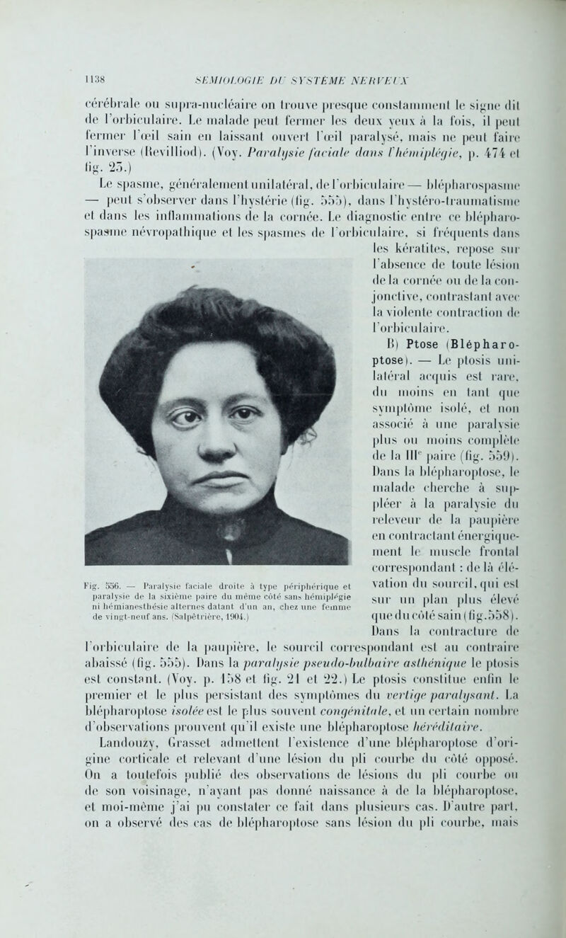 cérébrale ou supra-nucléaire on trouve presque constamment le signe dit de lorbiculaire. Le malade peut fermer les deux yeux à la fois, il peut fermer l’œil sain en laissant ouvert l'œil paralysé, mais ne peut faire I inverse (Bevilliod). (Voy. Paralysie faciale dans l'hémiplégie, p. 4-7i <*l lig. 23.) Le spasme, généralement unilatéral, de l orbiculaire— blépharospasme — peut s’observer dans l’hystérie (fîg. 555), dans l'hystéro-traumatisme et dans les inflammations de la cornée. Le diagnostic entre ce blépharo- spasme névropathique et les spasmes de l orbiculaire, si fréquents dans les kératites, repose sur l'absence de toute lésion de la cornée ou de la con- jonctive, contrastant avec la violente contraction de lorbiculaire. B) Ptose (Blépharo- ptose). — Le ptosis uni- latéral acquis est rare, du moins en tant que symptôme isolé, et non associé à une paralvsie plus ou moins complète de la III'' paire (fîg. 559). Dans la ldépliaroptose, le malade cherche à su |>- pléer à la paralysie du rcleveur de la paupière en contractant énergique- ment le muscle frontal correspondant : de là élé- vation du sourcil, qui est sur un plan plus élevé que du côté sain ( fi g. 558). Dans la contracture de l orbiculaire de la paupière, le sourcil correspondant est au contraire abaissé (fîg. 555). Dans la paralysie pseudo-lmlbaire asthénique le ptosis est constant. (Voy. p. 158 et fîg. 21 et 22.) Le ptosis constitue enfin le premier et le plus persistant des symptômes du vertige paralysant. La ldépliaroptose isoléeest le plus souvent congénitale, et un certain nombre d'observations prouvent qu'il existe une ldépliaroptose héréditaire. Landouzy, Grasset admettent l'existence d’une ldépliaroptose d’ori- gine corticale et relevant d’une lésion du pli courbe du côté opposé. On a toutefois publié des observations do lésions du pli courbe ou de son voisinage, n'ayant pas donné naissance à de la ldépliaroptose, et moi-même j’ai pu constater ce fait dans plusieurs cas. D'autre part, on a observé des cas de ldépliaroptose sans lésion du pli courbe, mais Fig. 556. — Paralysie faciale droite à type périphérique et paralysie de la sixième paire du même coté sans hémiplégie ni hémianesthésie alternes datant d’un an, chez une femme de vingt-neuf ans. (Salpêtrière, 1904.)