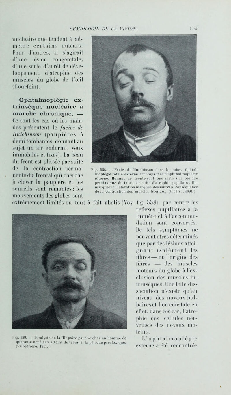 nucléaire que tendent à ad- mettre certains auteurs. Pour d’autres, il s’agirait d’une lésion congénitale, d'une soile d’arrêt de déve- loppement, d’atrophie des muscles du globe de l’œil (Gourfein). Ophtalmoplégie ex trinsèque nucléaire à marche chronique. — Ce sont les cas où les mala- des présentent le faciès de Hutchinson (paupières à demi tombantes, donnant au sujet un air endormi, yeux immobiles et fixes). La peau du Iront est plissée par suite de la contraction perma- nente du frontal qui cherche à élever la paupière et les sourcils sont remontés; les mouvements des globes sont extrêmement limités ou tout à fait abolis (Yoy. fig. ù58), par contre les réflexes pupillaires à la lumière et à l’acconnno- dation sont conservés. De tels symptômes ne peuvent êtres déterminés que par des lésions attei- gnant isolément les libres — ou l'origine des libres — des muscles moteurs du globe à l ex- clusion des muscles in- trinsèques. Une telle dis- sociation n’existe qu’au niveau des noyaux bul- baires et l’on constate en effet, dans ces cas, I atro- phie des cellules ner- veuses des novaux mo- Fig. 558. — Faciès de llulcliinson dans le tabes. Ophtal- moplégie totale externe accompagnée d’ophthalmoplégie interne. Homme de trente-sept ans resté à la période préataxique du tabes par suite d’atrophie papillaire, re- marquer ici l’élévation marquée des sourcils, conséquence de la contraction des muscles frontaux. (liicêtre, 1891.) tours. Fig. 559. — Paralysie de la IIP paire gauche chez un homme de h ’ o i)|) | ;j | m o n | p o j<> quarante-neuf ans atteint de tabes à la période préataxique. 1 , (Salpêtrière, 1911.) CXtOl lie îl olf miCOllIrOO