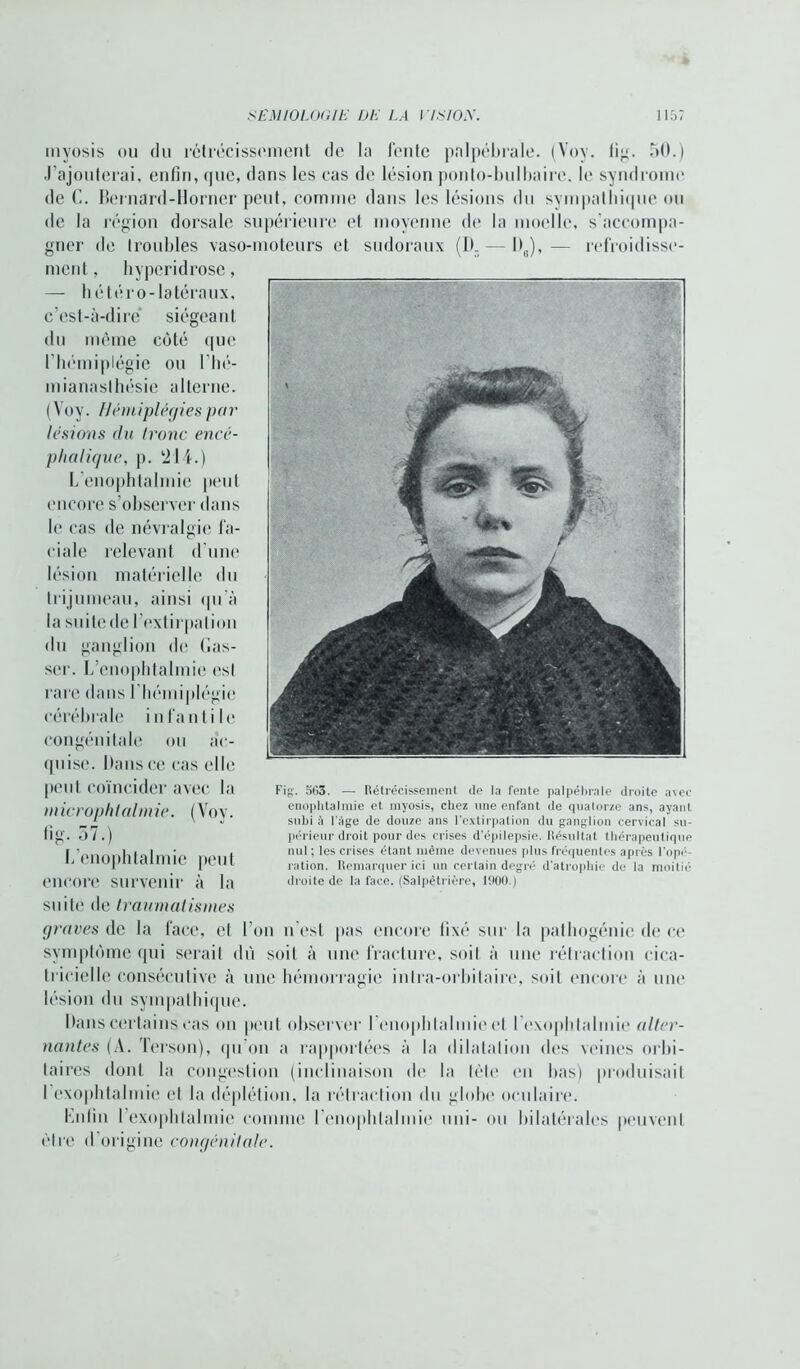 myosis ou du rétrécissement de la fente palpébrale. (Vov. lig. 50.) J’ajouterai, enfin, (pie, dans les cas de lésion ponlo-bulbairc. le syndrome de C. Beinard-Horner peut, comme dans les lésions du sympathique ou de la région dorsale supérieure et moyenne de la moelle, s’accompa- gner de troubles vaso-moteurs et sudoraux (D. — l)J,— refroidisse- ment, hypcridrose, — hétéro-latéraux, c’est-à-dire siégeant du même côté que l’hémiplégie ou l'hé- mianaslhésie alterne. (Voy. Hémiplégies par lésions du Ironc encé- phalique, p. ‘214.) L’enophtalmie peut encore s’observer dans le cas de névralgie fa- ciale relevant d’une lésion matérielle <1 u trijumeau, ainsi qu’à la suite de l’extirpation du ganglion de (las- ser. L’enophtalmie est rare dans l’hémiplégie cérébrale infantile congénitale ou ac- quise. Dans ce cas elle peut coïncider avec la ni icrophtalmie. ( Voy. fi g- 37.) L’enophtalmie peut encore survenir à la suite de traumatismes graves de la face, et l’on n’est pas encore fixé sur la pathogénie de ce symptôme qui serait dû soit à une fracture, soit à une rétraction cica- tricielle consécutive à une hémorragie inlra-orbilaire, soit encore à une lésion du sympathique. Dans certains cas on peut observer I enophtalmie et l’exophtalmie alter- nantes (A. Tcrson), qu'on a rapportées à la dilatation des veines orbi- taires dont la congestion (inclinaison de la tète en bas) produisait I exophtalmie et la déplétion, la rétraction du globe oculaire. Enfin l’exophtalmie comme l’enophtalmie uni- ou bilatérales peuvent être d’origine congénitale. Fig. o()3. — Rétrécissement de la fente palpébrale droite avec enophtalmie et myosis, chez une enfant de quatorze ans, ayant subi à l’âge de douze ans l’extirpation du ganglion cervical su- périeur droit pour des crises d’épilepsie. Résultat thérapeutique nul ; les crises étant même devenues plus fréquentes après l’opé- ration. Remarquer ici un certain degré d'atrophie de la moitié droite de la face. (Salpêtrière, 1900.)