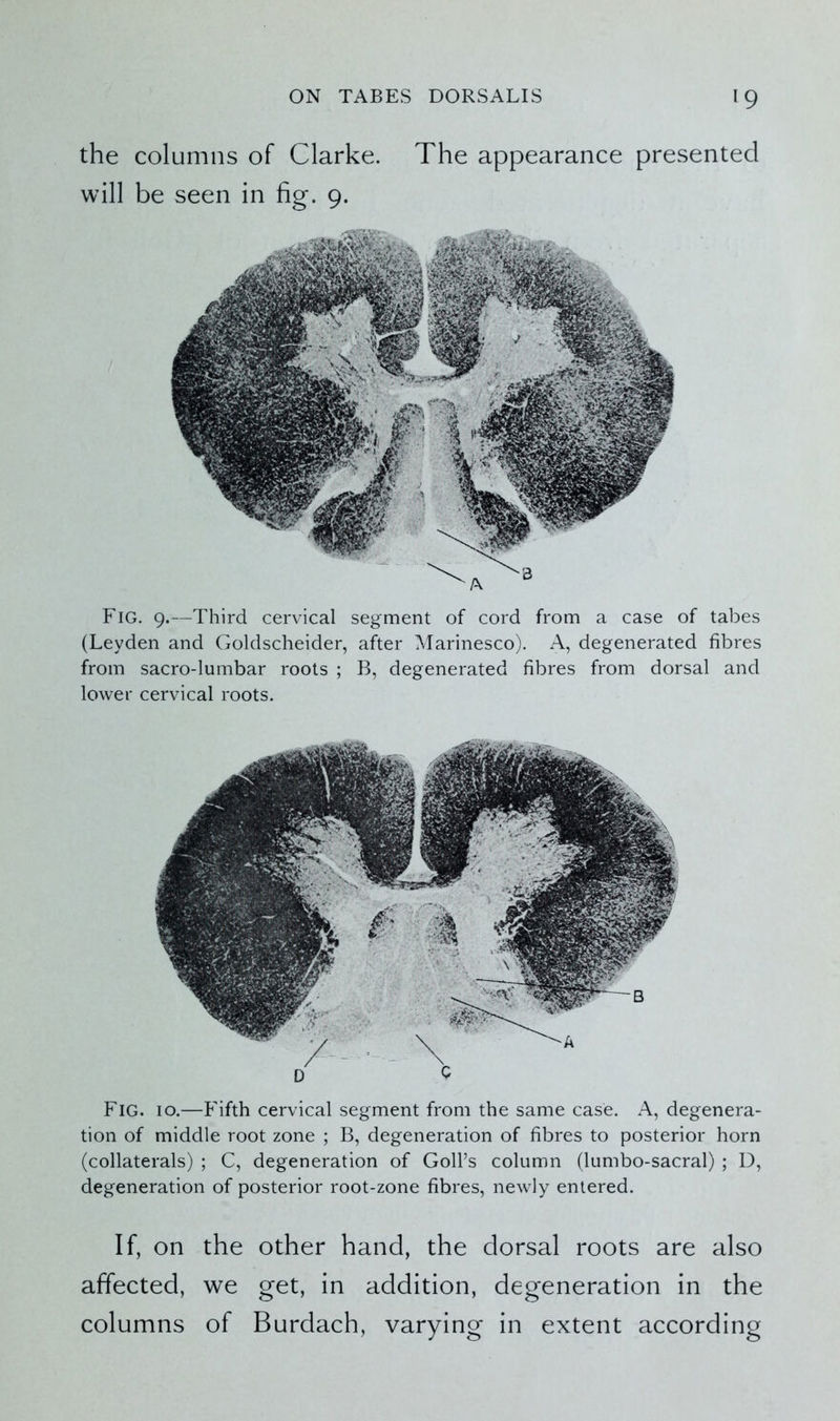 the columns of Clarke. The appearance presented will be seen in fig. 9. Fig. 9.—Third cervical segment of cord from a case of tabes (Leyden and Goldscheider, after Marinesco). A, degenerated fibres from sacro-lumbar roots ; B, degenerated fibres from dorsal and lower cervical roots. Fig. 10.—Fifth cervical segment from the same case. A, degenera- tion of middle root zone ; B, degeneration of fibres to posterior horn (collaterals) ; C, degeneration of Goll’s column (lumbo-sacral) ; D, degeneration of posterior root-zone fibres, newly entered. If, on the other hand, the dorsal roots are also affected, we get, in addition, degeneration in the columns of Burdach, varying in extent according