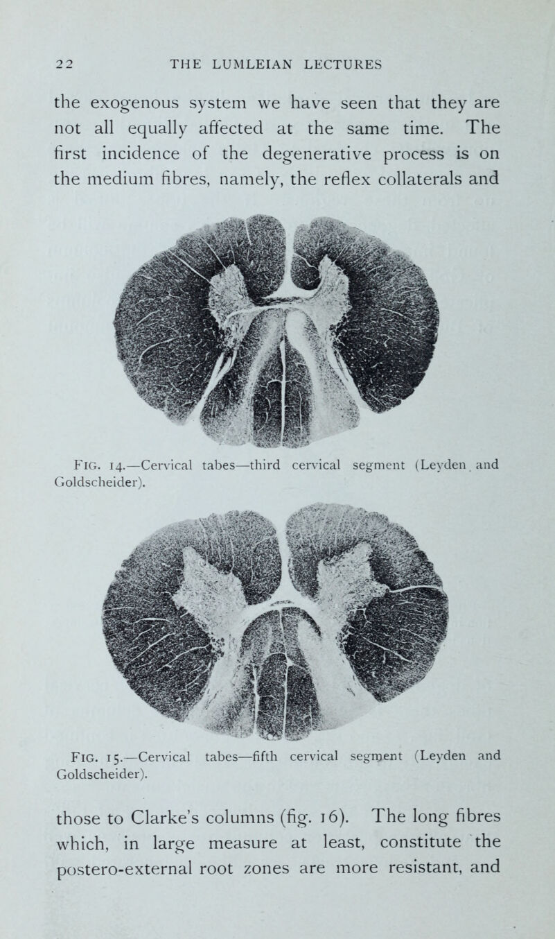 the exogenous system we have seen that they are not all equally affected at the same time. The first incidence of the degenerative process is on the medium fibres, namely, the reflex collaterals and Fig. 14.—Cervical tabes—third cervical segment (Leyden and Goldscheider). Fig. 15.—Cervical tabes—fifth cervical segment (Leyden and Goldscheider). those to Clarke’s columns (fig. 16). The long fibres which, in large measure at least, constitute the postero-external root zones are more resistant, and