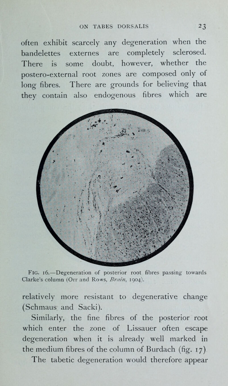 often exhibit scarcely any degeneration when the bandelettes externes are completely sclerosed. There is some doubt, however, whether the postero-external root zones are composed only of long fibres. There are grounds for believing that they contain also endogenous fibres which are Fig. 16.—Degeneration of posterior root fibres passing towards Clarke’s column (Orr and Rows, Brain, 1904). relatively more resistant to degenerative change (Schmaus and Sacki). Similarly, the fine fibres of the posterior root which enter the zone of Lissauer often escape degeneration when it is already well marked in the medium fibres of the column of Burdach (fig. 17) The tabetic degeneration would therefore appear