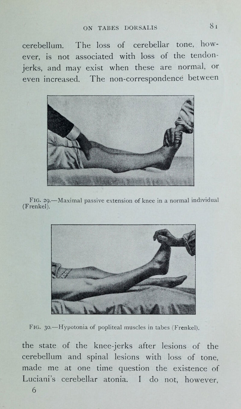 8 1 cerebellum. The loss of cerebellar tone, how- ever, is not associated with loss of the tendon- jerks, and may exist when these are normal, or even increased. The non-correspondence between Fig. 29.—Maximal passive extension of knee in a normal individual (Frenkel). Fig. 30.—Hypotonia of popliteal muscles in tabes (Frenkel). the state of the knee-jerks after lesions of the cerebellum and spinal lesions with loss of tone, made me at one time question the existence of Luciani’s cerebellar atonia. I do not, however, 6