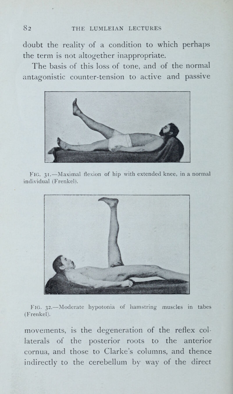 doubt the reality of a condition to which perhaps the term is not altogether inappropriate. The basis of this loss of tone, and of the normal antagonistic counter-tension to active and passive Fig. 31.—Maximal flexion of hip with extended knee, in a normal individual (Frenkel). Fig. 32.—Moderate hypotonia of hamstring muscles in tabes (Frenkel). movements, is the degeneration of the reflex col- laterals of the posterior roots to the anterior cornua, and those to Clarke’s columns, and thence indirectly to the cerebellum by way of the direct