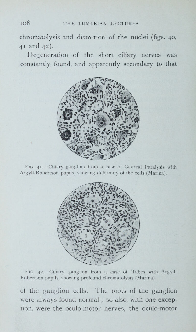 chromatolysis and distortion of the nuclei (figs. 40, 41 and 42). Degeneration of the short ciliary nerves was constantly found, and apparently secondary to that Fig. 41.—Ciliary ganglion from a case of General Paral>sis with Argyll-Robertson pupils, showing deformity of the cells (Marina). Fig. 42.—Ciliary ganglion from a case of Tabes with Argyll- Robertson pupils, showing profound chromatolysis (Marina). of the ganglion cells. The roots of the ganglion were always found normal ; so also, with one excep- tion, were the oculo-motor nerves, the oculo-motor