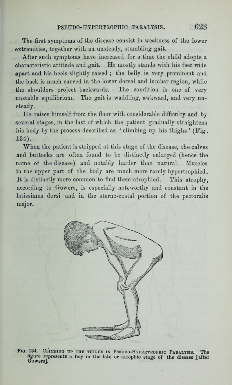 The first symptoms of the disease consist in weakness of the lower extremities, together with an unsteady, stumbling gait. After such symptoms have increased for a time the child adopts a characteristic attitude and gait. He mostly stands with his feet wide apart and his heels slightly raised ; the belly is very prominent and the back is much curved in the lower dorsal and lumbar region, while the shoulders project backwards. The condition is one of very unstable equilibrium. The gait is waddling, awkward, and very un- steady. He raises himself from the floor with considerable difficulty and by several stages, in the last of which the patient gradually straightens his body by the process described as 1 climbing up his thighs ’ (Fig. 134). When the patient is stripped at this stage of the disease, the calves and buttocks are often found to be distinctly enlarged (hence the name of the disease) and notably harder than natural. Muscles in the upper part of the body are much more rarely hypertrophied. It is distinctly more common to find them atrophied. This atrophy, according to Gowers, is especially noteworthy and constant in the latissimus dorsi and in the sterno-costal portion of the pectoralis major. Fig. 134. Climbing up the thighs in Pseudo-Hypertrophic Paralysis. The figure represents a boy in the late or atrophic stage of the disease [after Gowers].