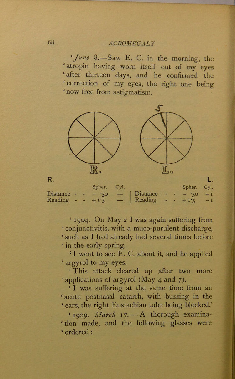 \June 8.—Saw E. C. in the morning, the ‘ atropin having worn itself out of my eyes ‘ after thirteen days, and he confirmed the ‘ correction of my eyes, the right one being ‘ now free from astigmatism. R. Spher. Cyl. Distance - - - ‘50 — Reading - - +i’5 — ILo L. Spher. Cyl. Distance - - - *50 -1 Reading - - +1*5 -1 ‘ 1904, On May 2 I was again suffering from ‘ conjunctivitis, with a muco-purulent discharge, ‘ such as I had already had several times before ‘ in the early spring. ‘ I went to see E. C. about it, and he applied ^ argyrol to my eyes. ‘ This attack cleared up after two more ‘applications of argyrol (May 4 and 7). ‘ I was suffering at the same time from an ‘ acute postnasal catarrh, with buzzing in the ‘ ears, the right Eustachian tube being blocked.’ ‘1909. March 17. — A thorough examina- ‘ tion made, and the following glasses were ‘ ordered :