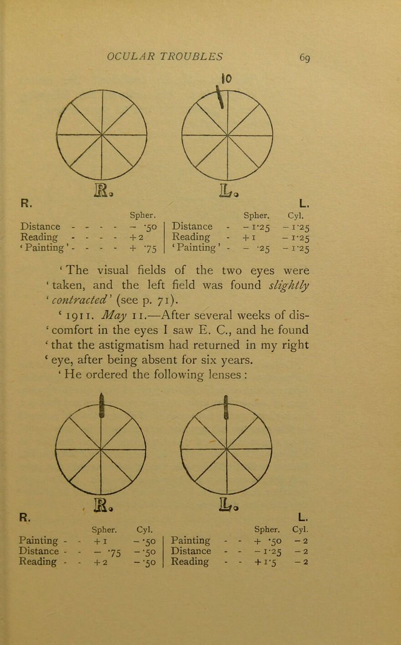 R. Distance - - - - Spher. ■- -50 Distance Spher. - 1*25 L. Cyl. - 1-25 Reading - - . - + 2 Reading ‘Painting’ - + I - 1-25 ‘ Painting ’. - - - + 75 - -25 -1-25 ‘ The visual fields of the two eyes were ‘ taken, and the left field was found slightly 'contracted' (see p. 71). ‘ 1911. May 11.—After several weeks of dis- ‘ comfort in the eyes I saw E. C., and he found ^ that the astigmatism had returned in my right ‘ eye, after being absent for six years. ‘ He ordered the following lenses : R. L. Spher. Cyl. Spher. Cyl. Painting - - +1 -•50 Painting - + -50 - 2 Distance - - - 75 -■50 Distance - -1-25 - 2