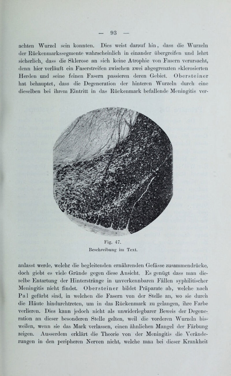 achten Wurzel sein konnten. Dies weist darauf hin, dass die Wurzeln der Rückenmarkssegmente wahrscheinlich in einander übergreifen und lehrt sicherlich, dass die Sklerose an sich keine Atrophie von Fasern verursacht, denn hier verläuft ein Faserstreifen zwischen zwei abgegrenzten sklerosierten Herden und seine feinen Fasern passieren deren Gebiet. Obersteiner hat behauptet, dass die Degeneration der hinteren Wurzeln durch eine dieselben bei ihrem Eintritt in das Rückenmark befallende Meningitis ver- Fig. 47. Beschreibung im Text. anlasst werde, welche die begleitenden ernährenden Gefässe zusammendrücke, doch giebt es viele Gründe gegen diese Ansicht. Es genügt dass man die- selbe Entartung der Hinterstränge in unverkennbaren Fällen syphilitischer Meningitis nicht findet. Obersteiner bildet Präparate ab, welche nach Pal gefärbt sind, in welchen die Fasern von der Stelle an, wo sie durch die Häute hindurchtreten, um in das Rückenmark zu gelangen, ihre Farbe verlieren. Dies kann jedoch nicht als unwiderlegbarer Beweis der Degene- ration an dieser besonderen Stelle gelten, weil die vorderen Wurzeln bis- weilen, wenn sie das Mark verlassen, einen ähnlichen Mangel der Färbung zeigen. Ausserdem erklärt die Theorie von der Meningitis die Verände- rungen in den peripheren Nerven nicht, welche man bei dieser Krankheit