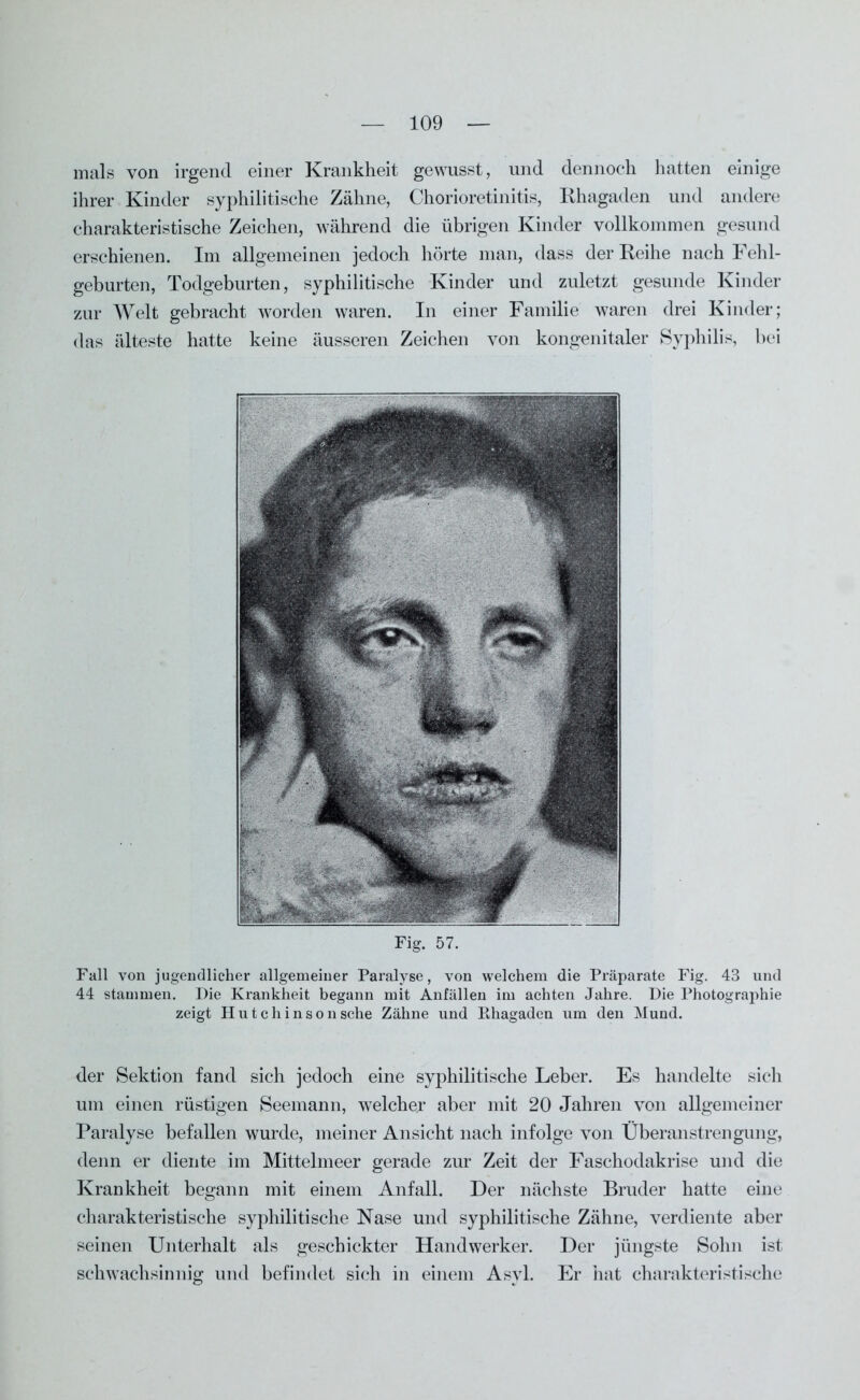 mals von irgend einer Krankheit gewusst, und dennoch hatten einige ihrer Kinder syphilitische Zähne, Chorioretinitis, Rhagaden und andere charakteristische Zeichen, während die übrigen Kinder vollkommen gesund erschienen. Im allgemeinen jedoch hörte man, dass der Reihe nach Fehl- geburten, Todgeburten, syphilitische Kinder und zuletzt gesunde Kinder zur Welt gebracht worden waren. In einer Familie waren drei Kinder; das älteste hatte keine äusseren Zeichen von kongenitaler Syphilis, bei Fig. 57. Fall von jugendlicher allgemeiner Paralyse, von welchem die Präparate Fig. 43 und 44 stammen. Die Krankheit begann mit Anfällen im achten Jahre. Die Photographie zeigt Hutchinson sehe Zähne und Rhagaden um den Mund. der Sektion fand sich jedoch eine syphilitische Leber. Es handelte sich um einen rüstigen Seemann, welcher aber mit 20 Jahren von allgemeiner Paralyse befallen wurde, meiner Ansicht nach infolge von Überanstrengung, denn er diente im Mittelmeer gerade zur Zeit der Faschodakrise und die Krankheit begann mit einem Anfall. Der nächste Bruder hatte eine charakteristische syphilitische Nase und syphilitische Zähne, verdiente aber seinen Unterhalt als geschickter Handwerker. Der jüngste Sohn ist schwachsinnig und befindet sich in einem Asyl. Er hat charakteristische