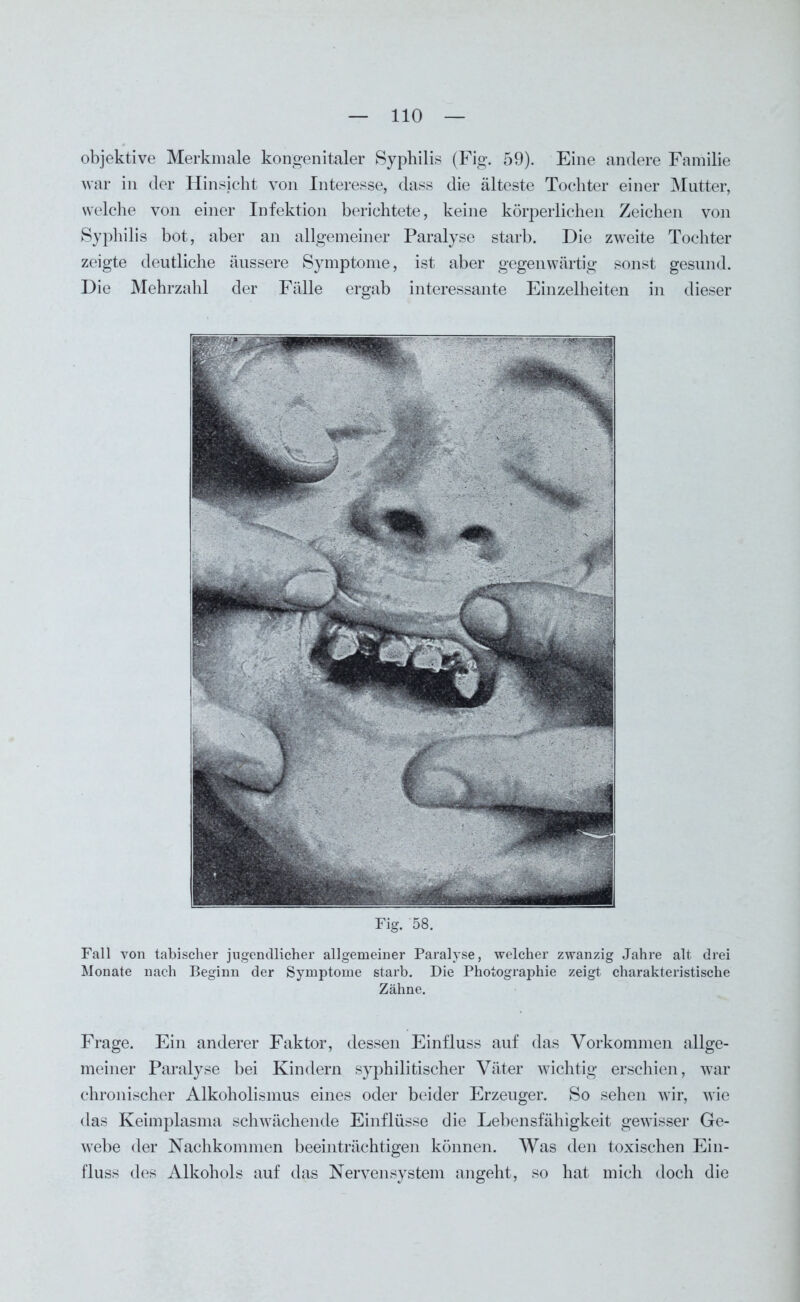 objektive Merkmale kongenitaler Syphilis (Fig. 59). Eine andere Familie war in der Hinsicht von Interesse, dass die älteste Tochter einer Mutter, welche von einer Infektion berichtete, keine körperlichen Zeichen von Syphilis bot, aber an allgemeiner Paralyse starb. Die zweite Tochter zeigte deutliche äussere Symptome, ist aber gegenwärtig sonst gesund. Die Mehrzahl der Fälle ergab interessante Einzelheiten in dieser Fig. 58. Fall von tabischer jugendlicher allgemeiner Paralyse, welcher zwanzig Jahre alt drei Monate nach Beginn der Symptome starb. Die Photographie zeigt charakteristische Zähne. Frage. Ein anderer Faktor, dessen Einfluss auf das Vorkommen allge- meiner Paralyse bei Kindern syphilitischer Väter wichtig erschien, war chronischer Alkoholismus eines oder beider Erzeuger. So sehen wir, wie das Keimplasma schwächende Einflüsse die Lebensfähigkeit gewisser Ge- webe der Nachkommen beeinträchtigen können. Was den toxischen Ein- fluss des Alkohols auf das Nervensystem angeht, so hat mich doch die