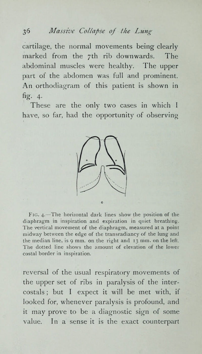 cartilage, the normal movements being clearly marked from the 7th rib downwards. The abdominal muscles were healthy. The upper part of the abdomen was full and prominent. An orthodiagram of this patient is shown in fig. 4. These are the only two cases in which I have, so far, had the opportunity of observing Fig. 4.—The horizontal dark lines show the position of the diaphragm in inspiration and expiration in quiet breathing. The vertical movement of the diaphragm, measured at a point midway between the edge of the transradiancy of the lung and the median line, is 9 mm. on the right and 13 mm. on the left. The dotted line shows the amount of elevation of the lower costal border in inspiration. reversal of the usual respiratory movements of the upper set of ribs in paralysis of the inter- costals ; but I expect it will be met with, if looked for, whenever paralysis is profound, and it may prove to be a diagnostic sign of some value. In a sense it is the exact counterpart