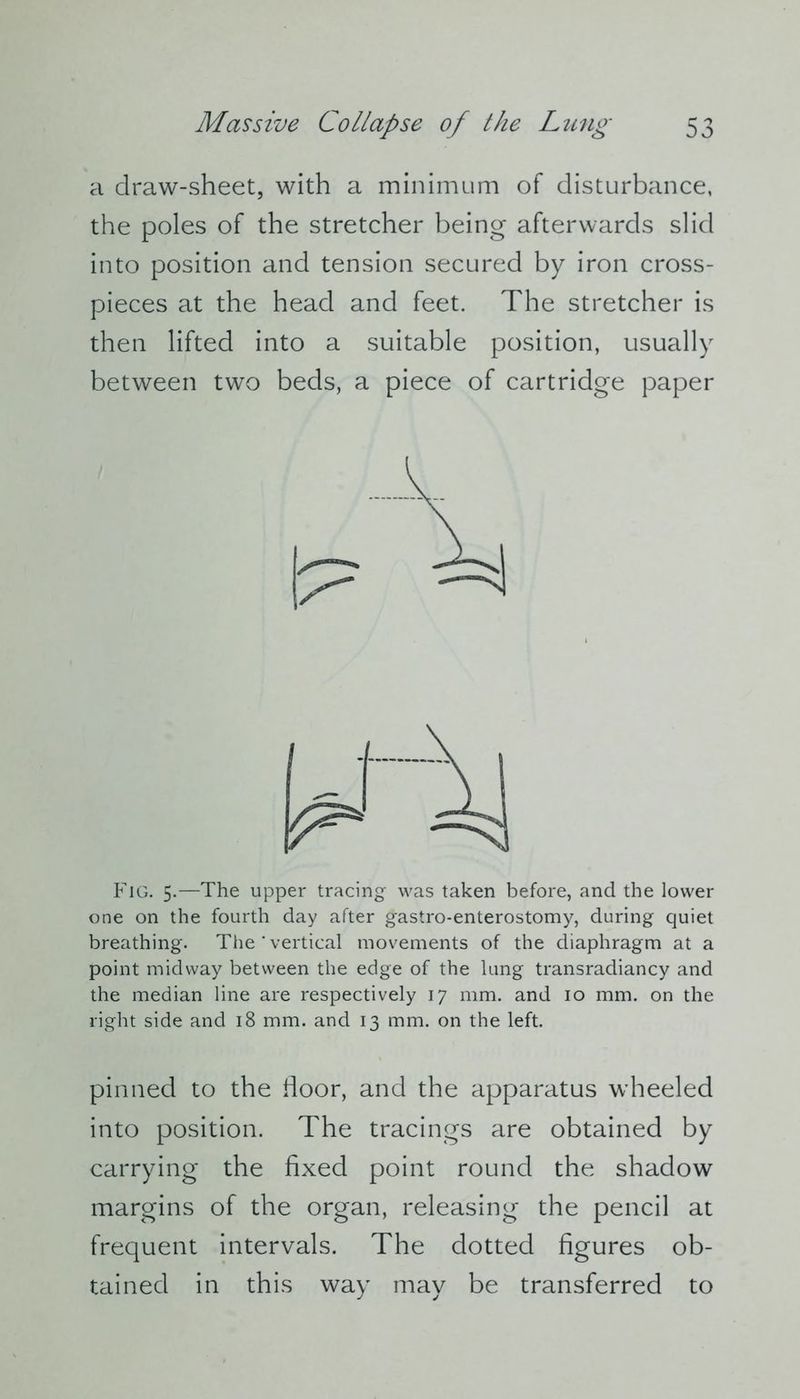 a draw-sheet, with a minimum of disturbance, the poles of the stretcher being afterwards slid into position and tension secured by iron cross- pieces at the head and feet. The stretcher is then lifted into a suitable position, usually between two beds, a piece of cartridge paper Fig. 5.—The upper tracing was taken before, and the lower one on the fourth day after gastro-enterostomy, during quiet breathing. The’vertical movements of the diaphragm at a point midway between the edge of the lung transradiancy and the median line are respectively 17 mm. and 10 mm. on the right side and 18 mm. and 13 mm. on the left. pinned to the door, and the apparatus wheeled into position. The tracings are obtained by carrying the fixed point round the shadow margins of the organ, releasing the pencil at frequent intervals. The dotted figures ob- tained in this way may be transferred to